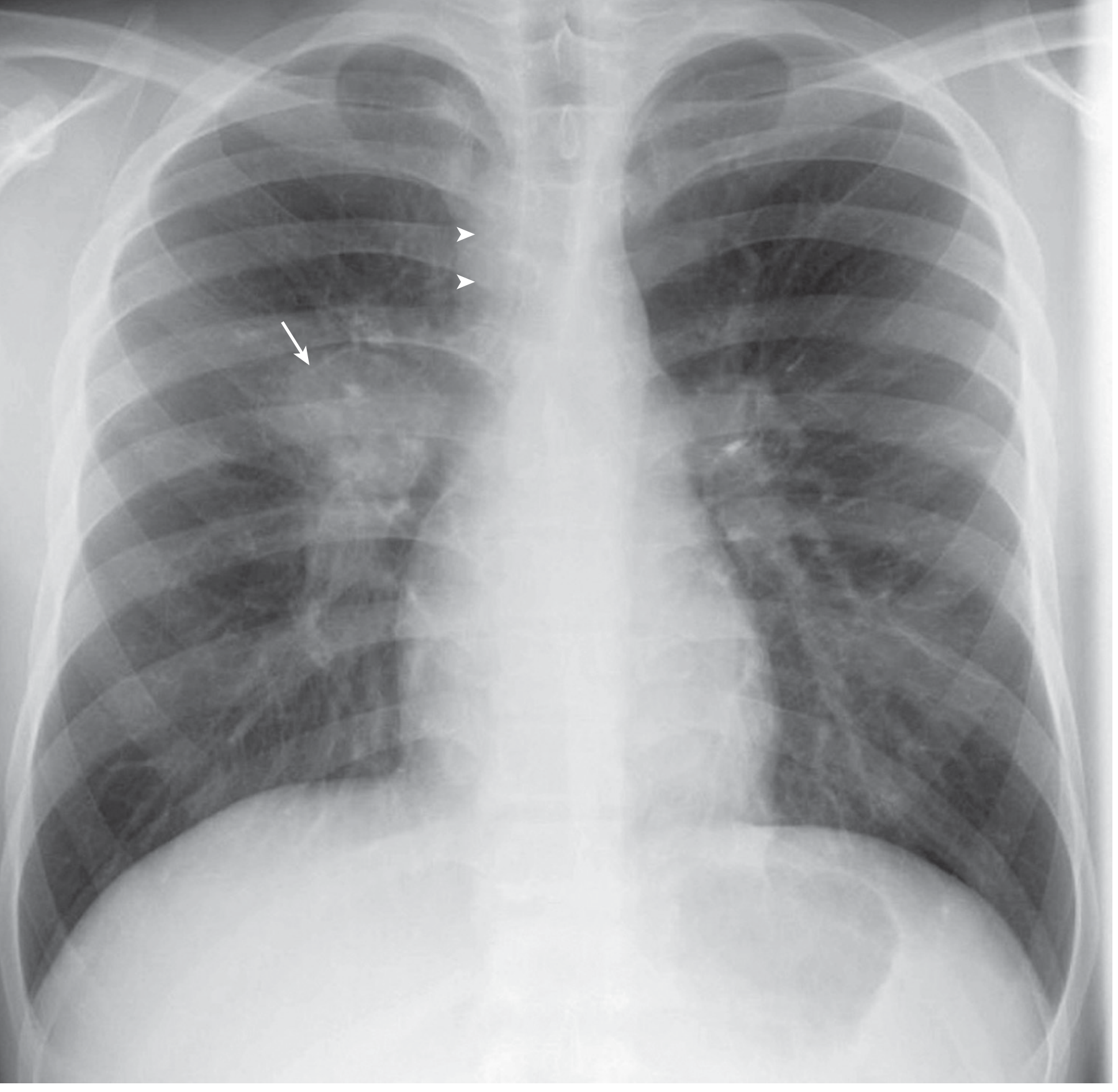 Hilar lymphadenopathy in TB