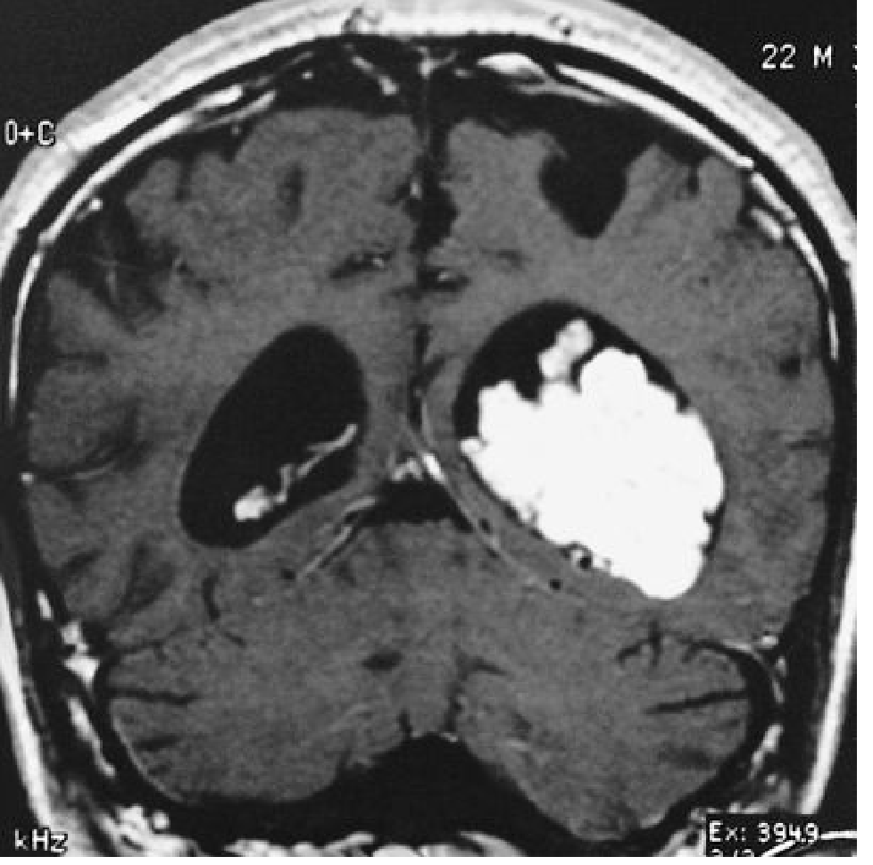 Choroid Plexus Papilloma - Coronal T1 post-gadolinium. Lobulated, strongly enhancing tumor in the trigone of the left lateral ventricle with bilateral hydrocephalus