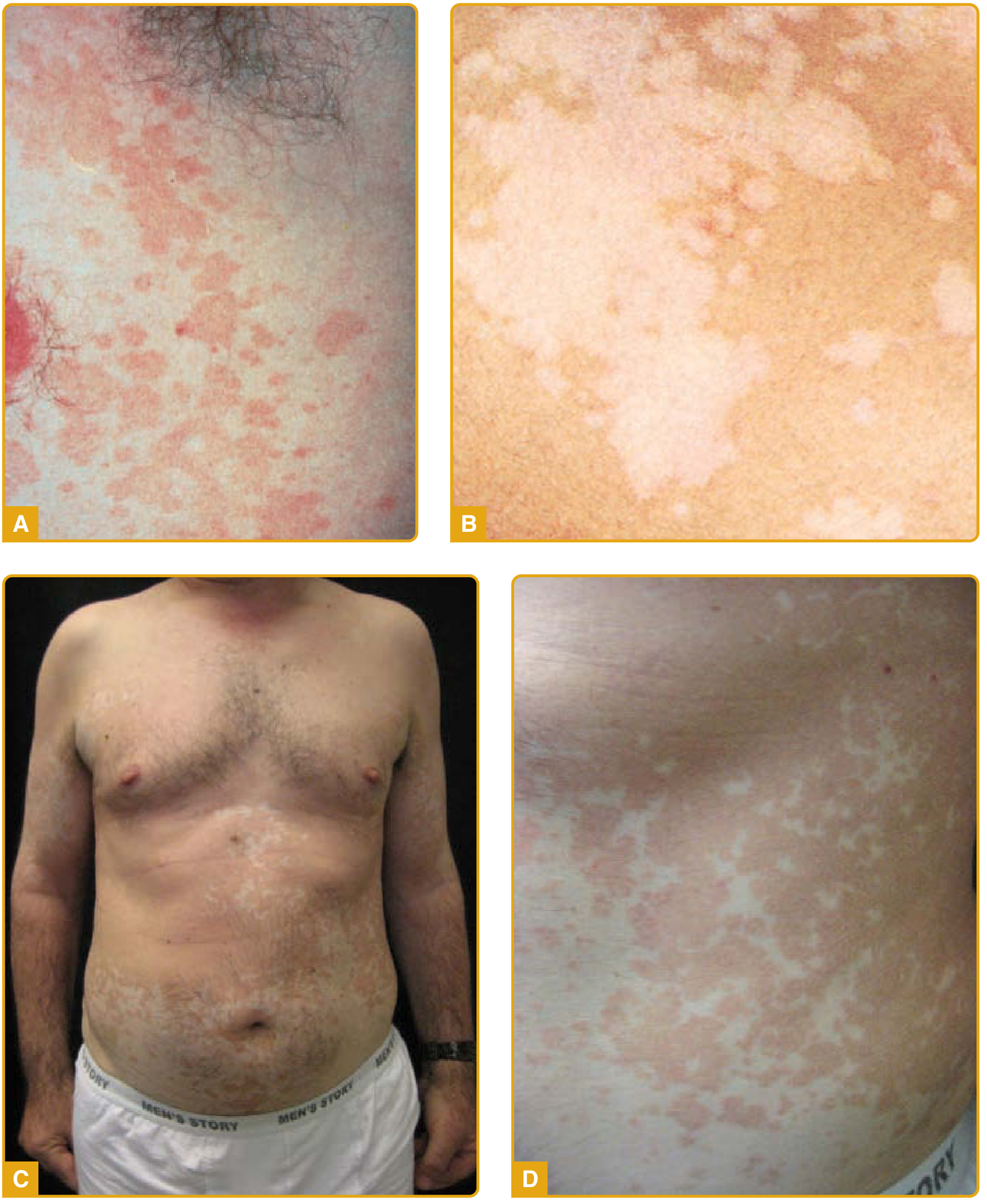 Clinical variants and fine scaling of pityriasis versicolor