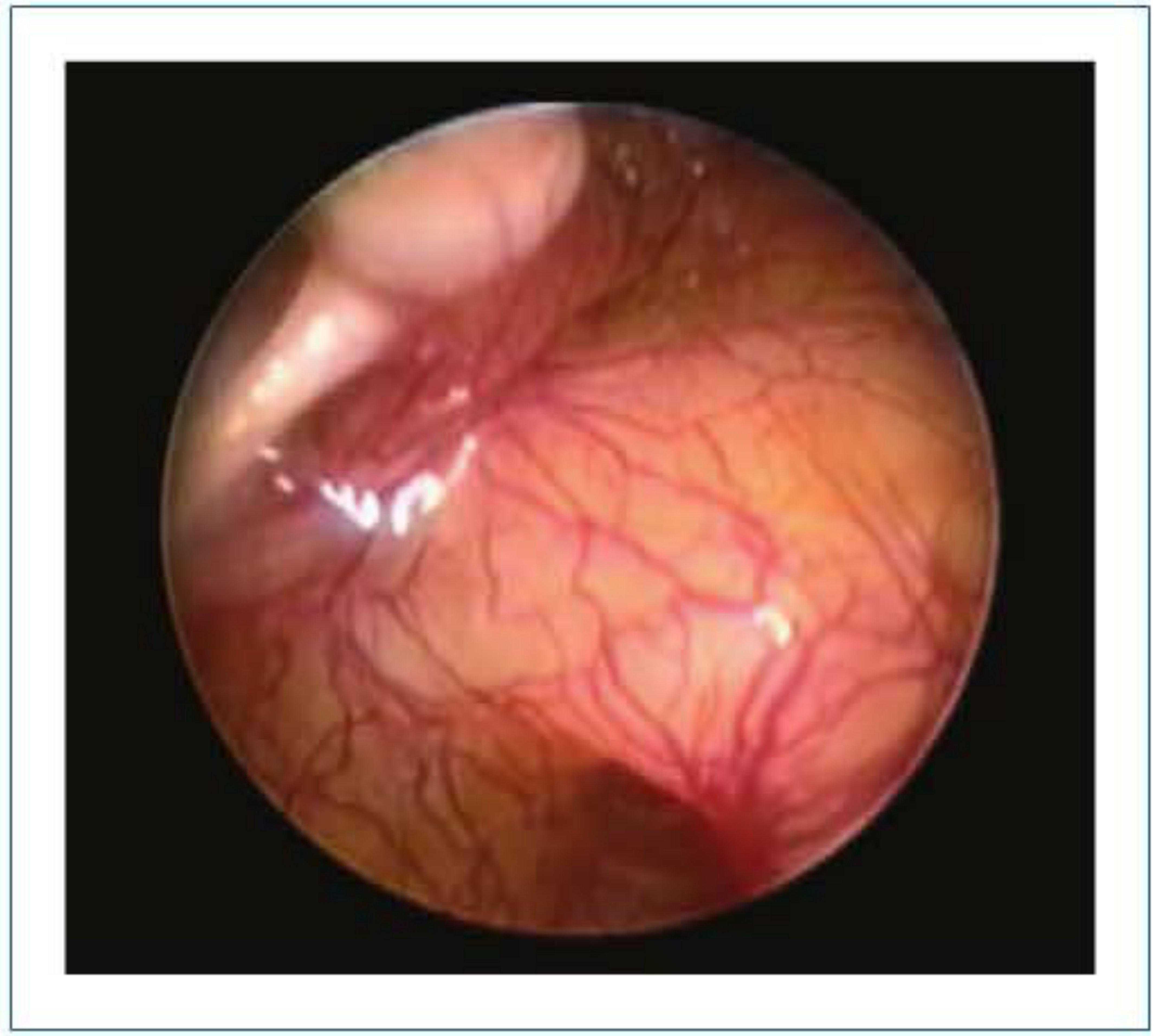 Transtympanic endoscopic view of the middle ear using a 1.9mm 0-degree Hopkins rod endoscope - wide panoramic view of the mesotympanum