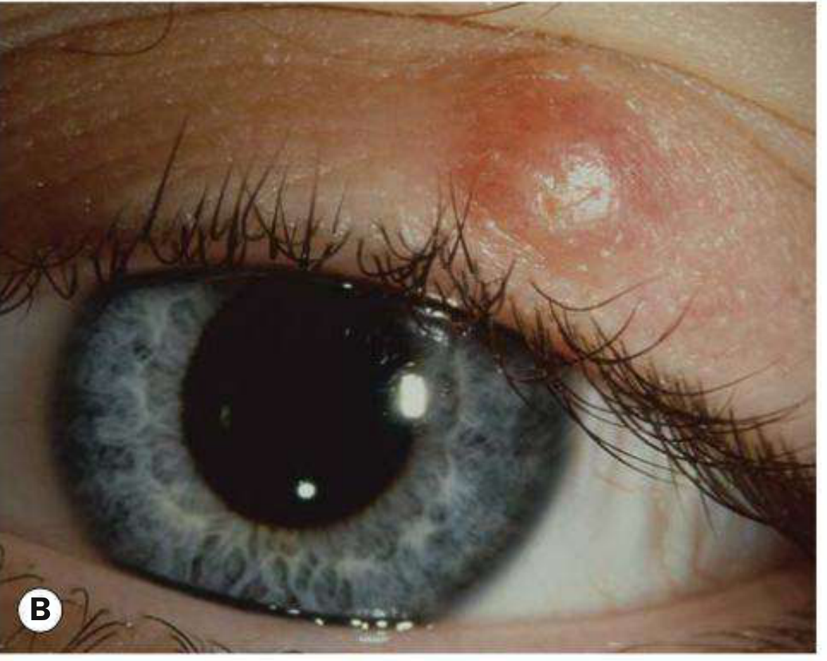 Uninflamed chalazion of the upper eyelid