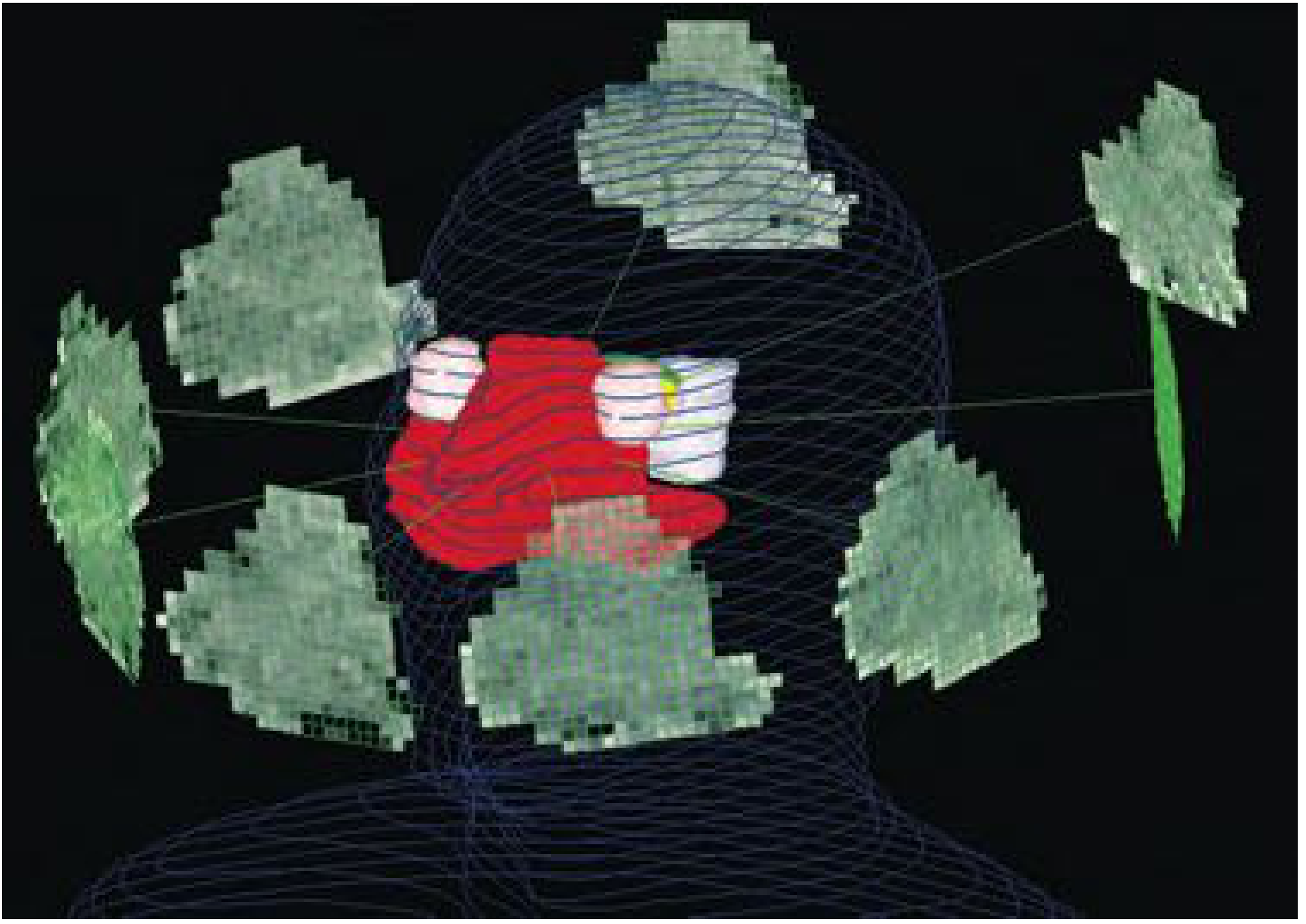 3D rendering of IMRT beam arrangement showing multiple MLC-shaped radiation fields converging on the oropharyngeal target (red) while avoiding eyes and critical structures - Cummings Otolaryngology