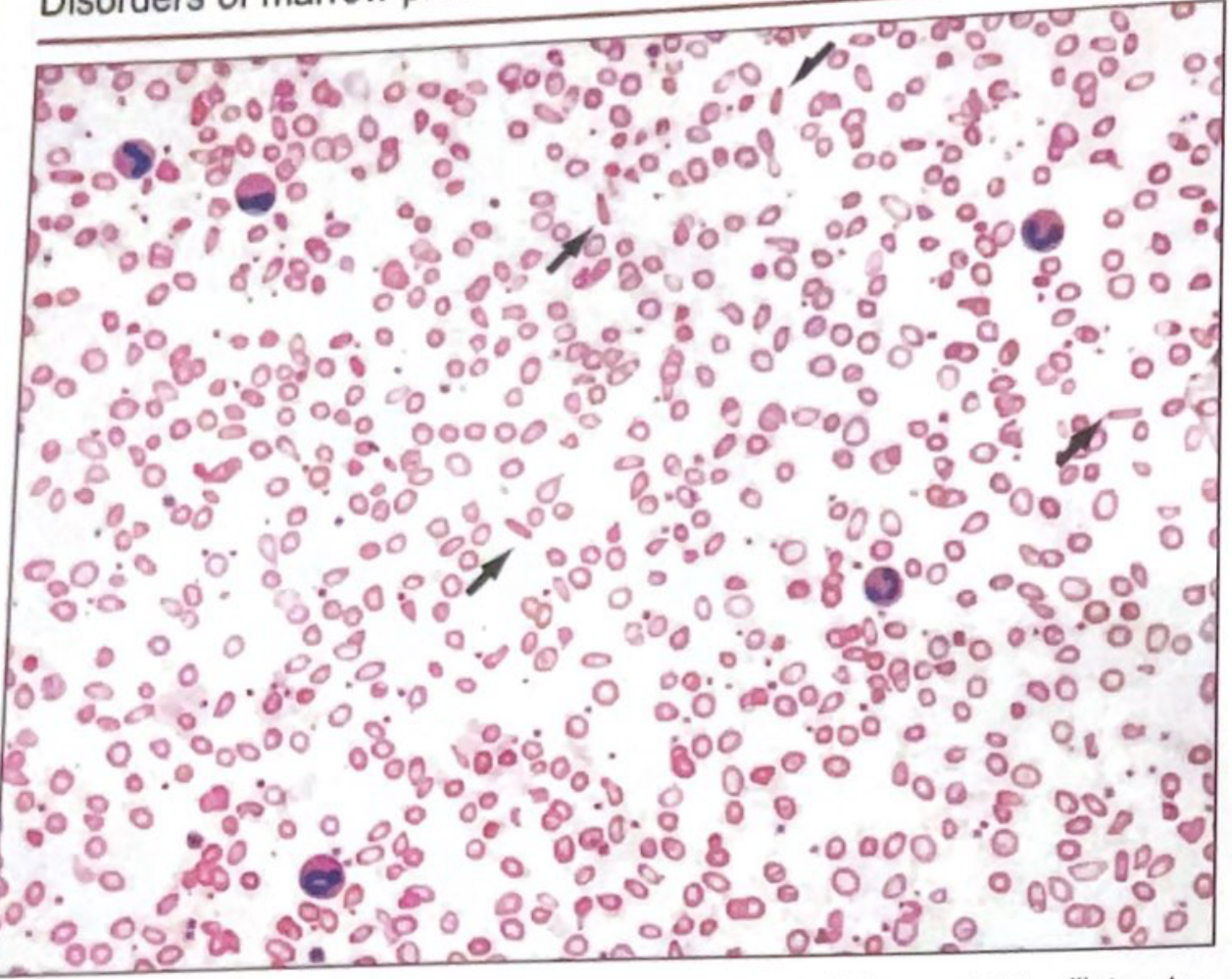 IDA blood smear - pencil cells