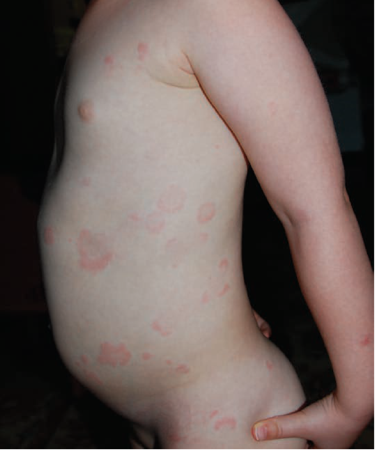 Urticaria - characteristic wheals on a child's torso