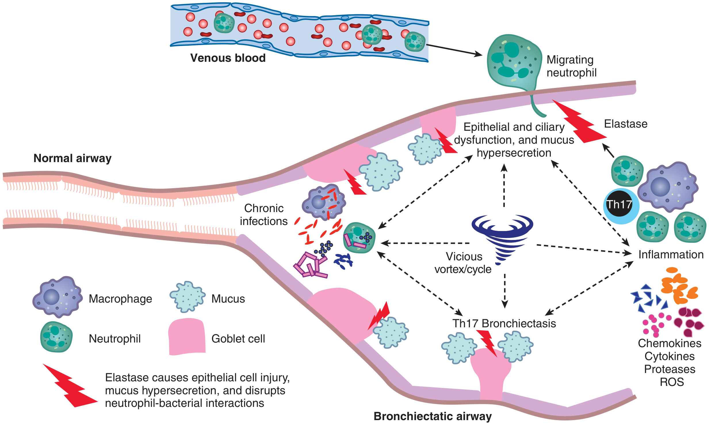 Cellular pathophysiology of bronchiectasis - "vicious vortex" - Murray & Nadel's