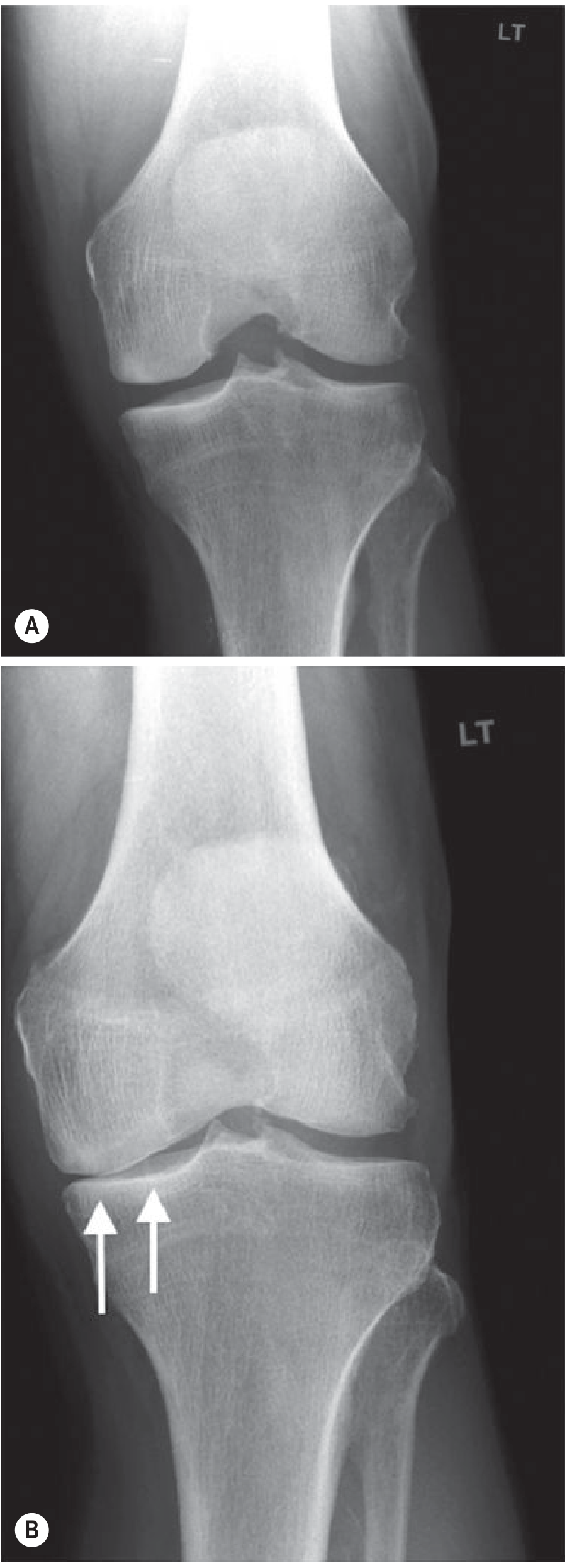 Knee OA weight-bearing comparison