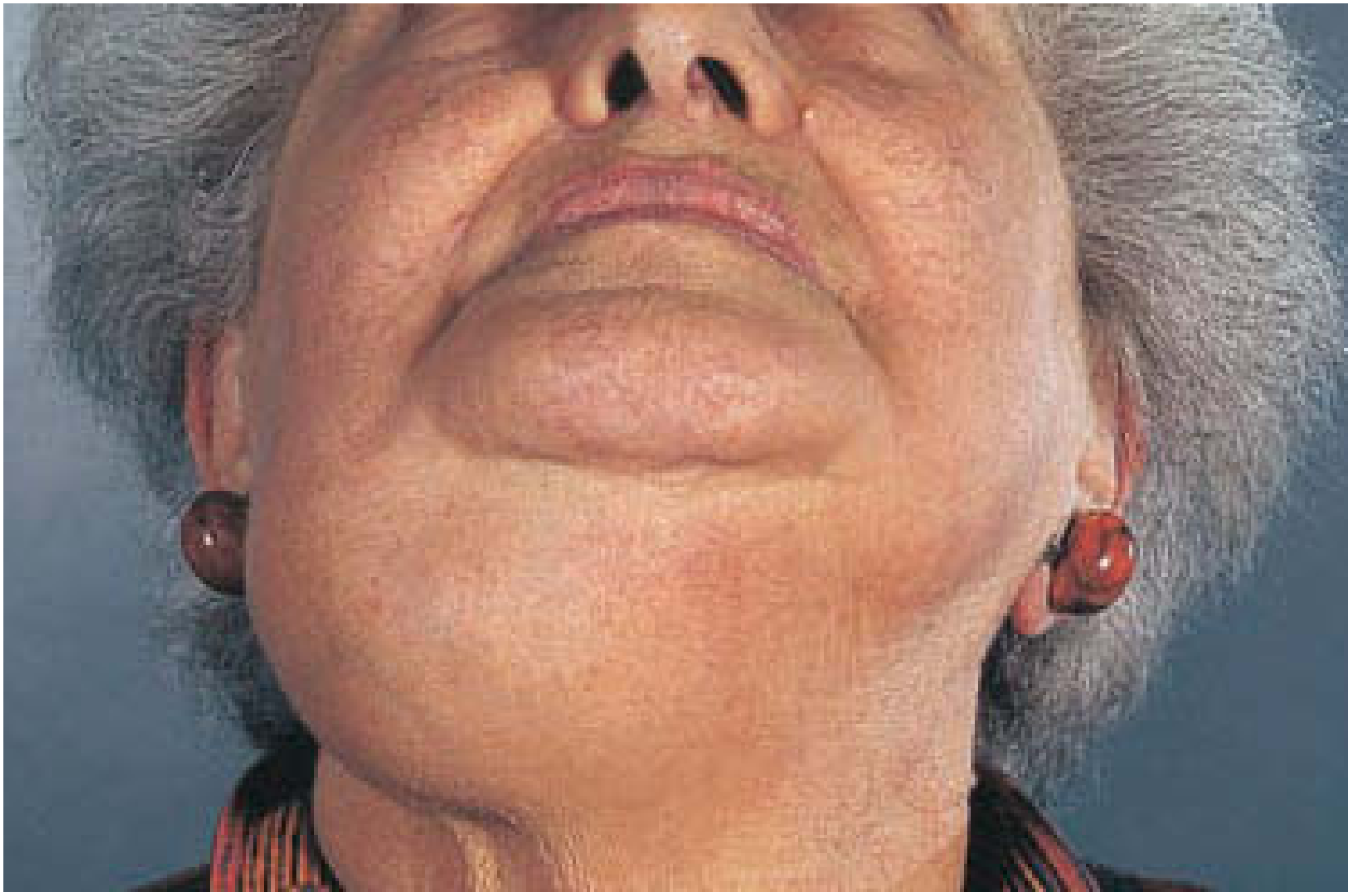 Submandibular pleomorphic adenoma presenting as a swelling in the submandibular triangle in an older woman