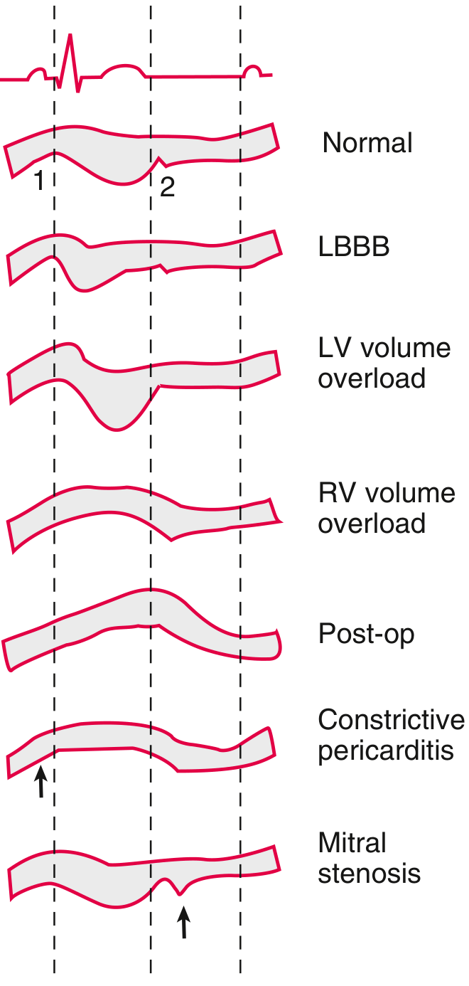 Patterns of septal motion on M-mode echocardiography