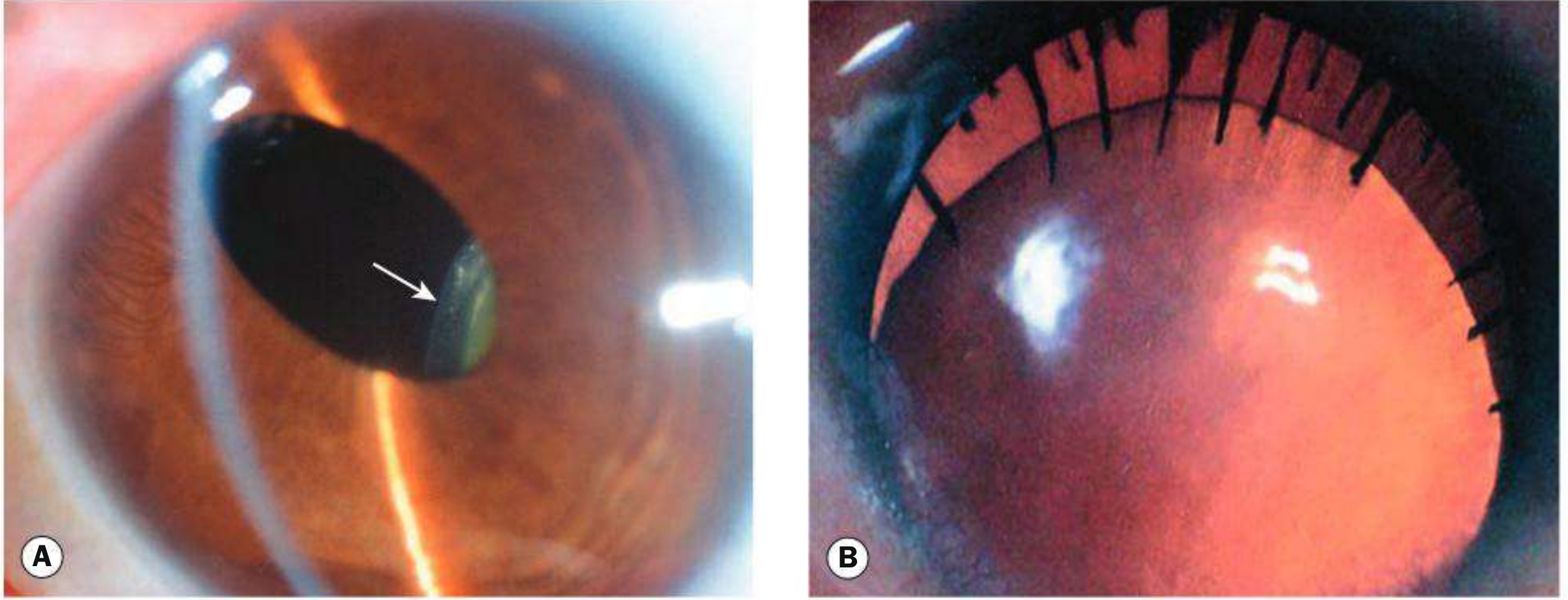 Ectopia lentis without systemic associations and inferior subluxation in aniridia