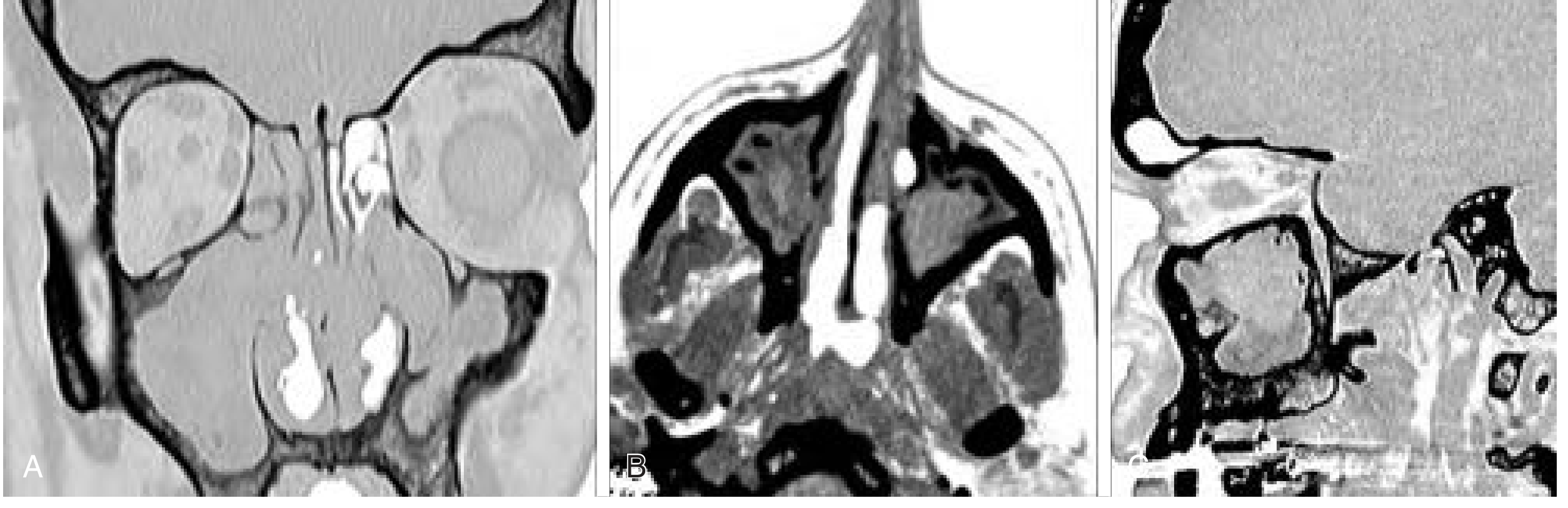 Bilateral CRS with calcification