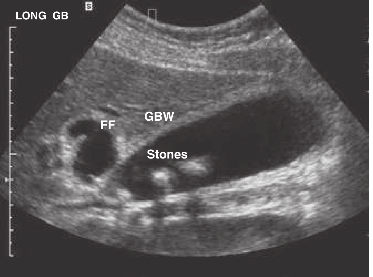 Gallbladder ultrasound showing stones, thickened wall, and pericholecystic fluid