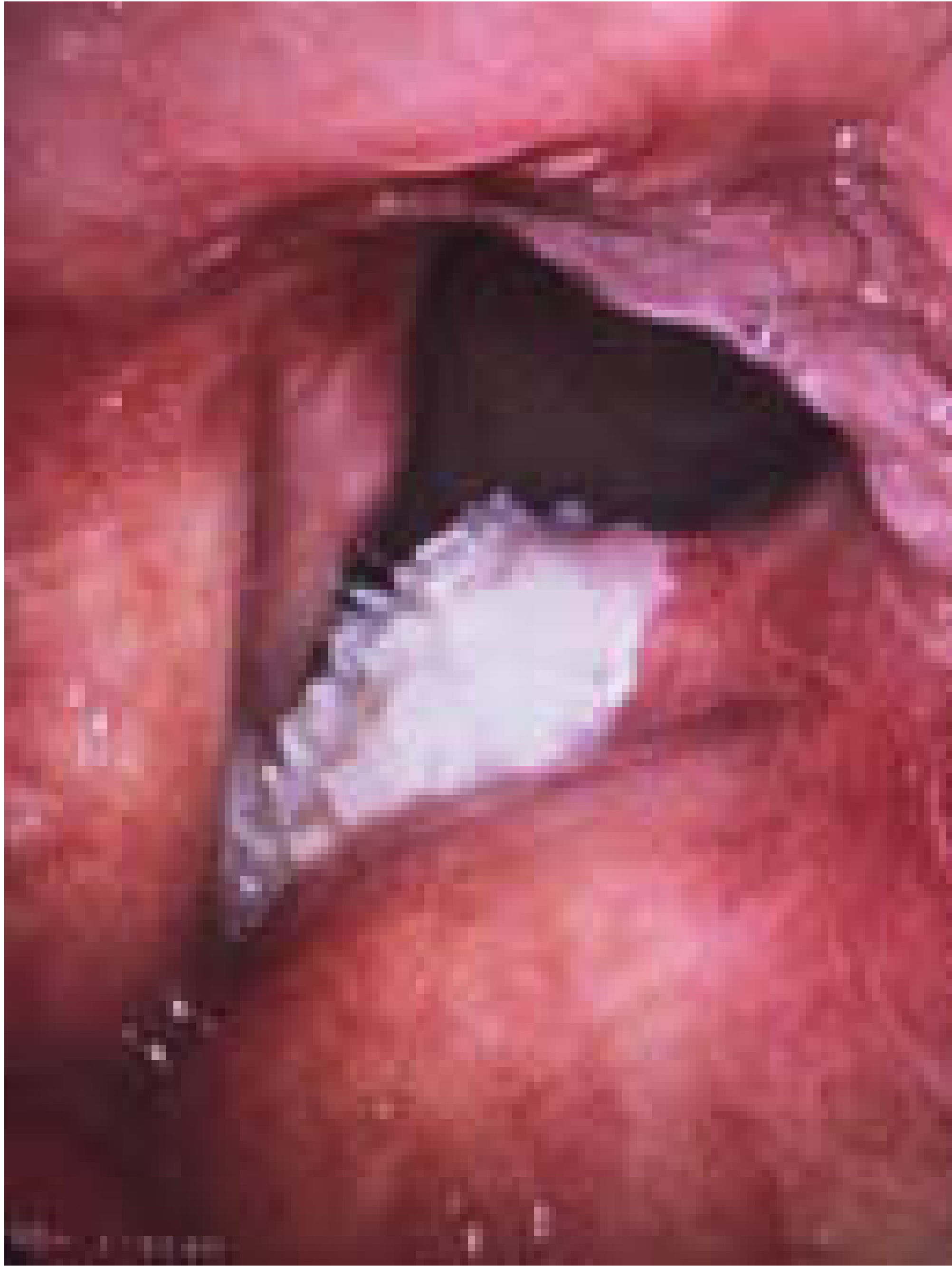 Figure 63.12 - Ackermann's tumour (verrucous carcinoma)