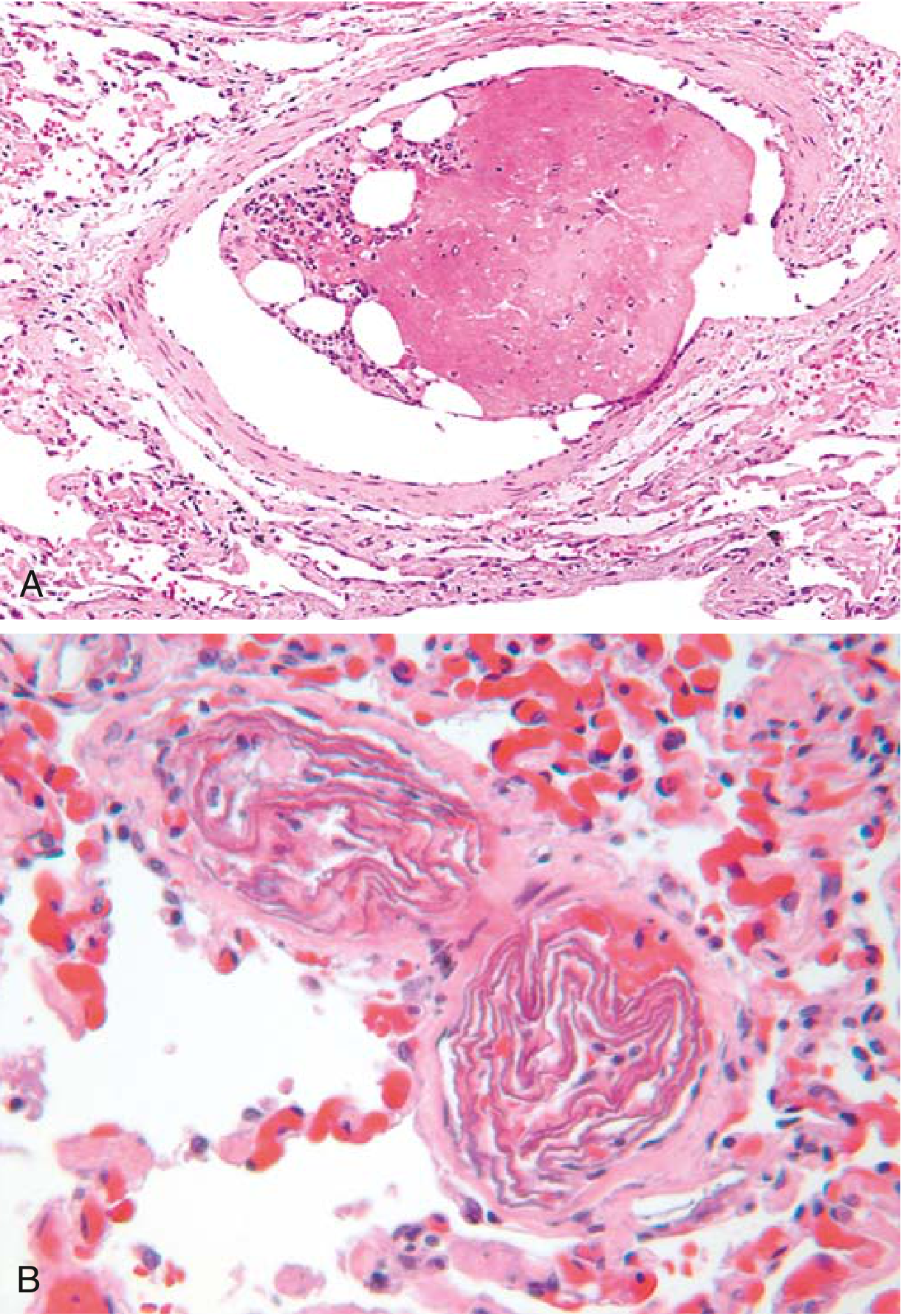 Fat embolism histology — fat embolus (A) composed of haematopoietic elements and fat cells (clear spaces) attached to thrombus; (B) amniotic fluid emboli with fetal squamous cells in pulmonary arterioles — Robbins & Kumar Basic Pathology Fig. 3.16