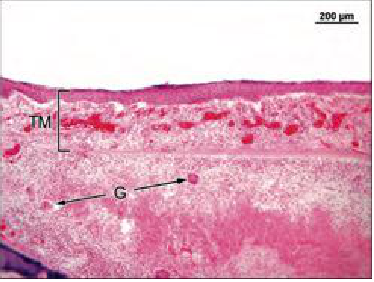 Histology of the TM thickened by tuberculous granulation tissue with giant cells
