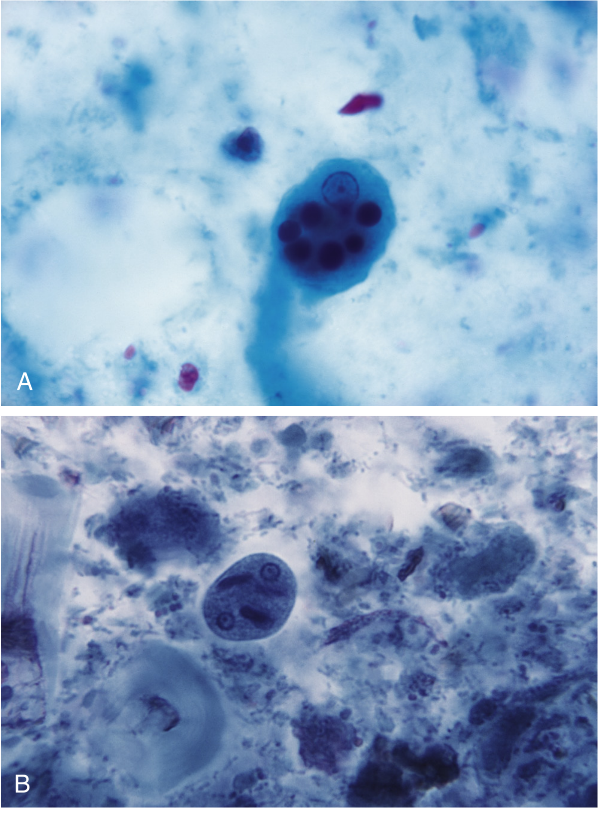 E. histolytica trophozoite (A) and cysts (B) - note rounded chromatoid bars and nuclei