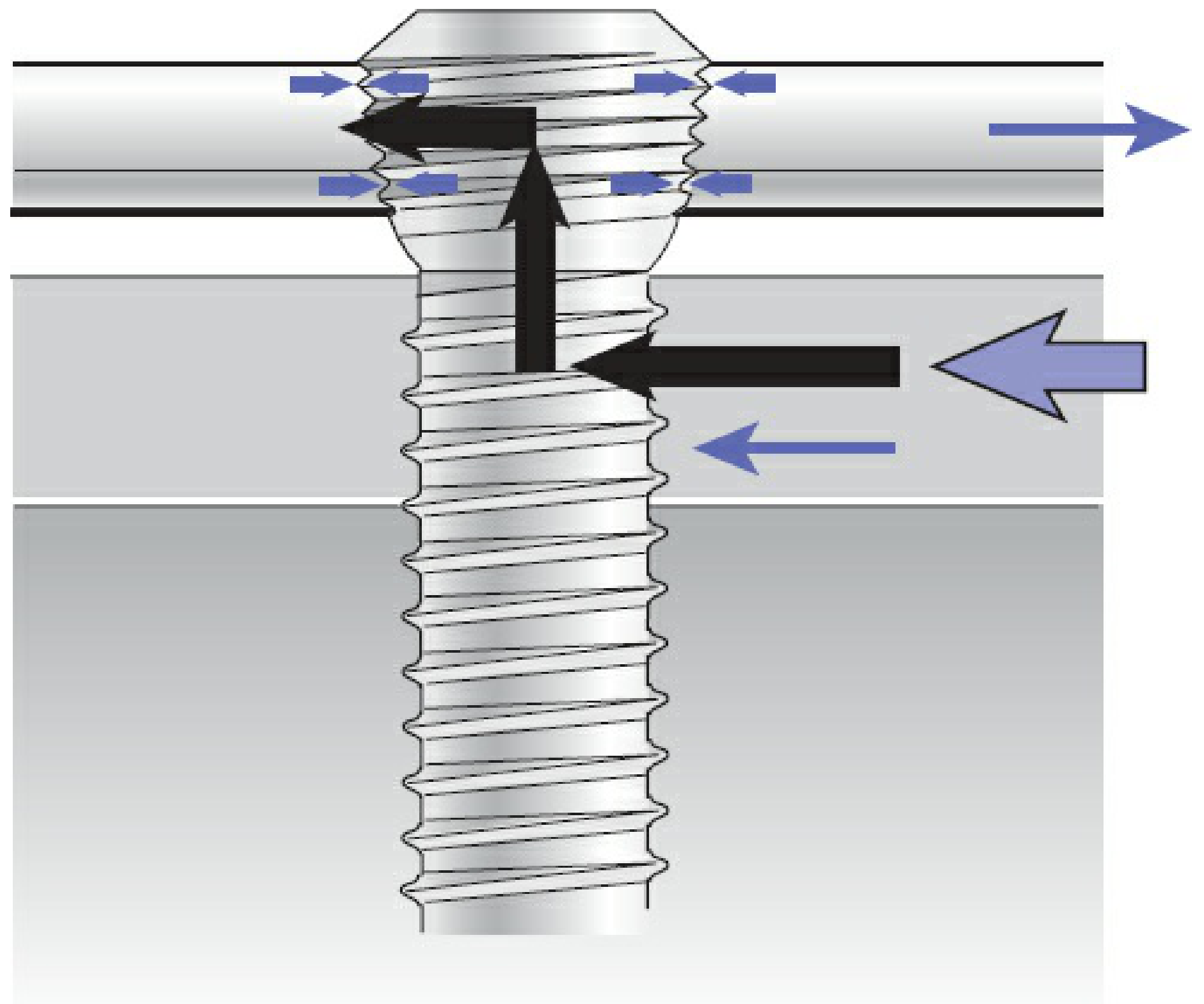 Force transfer in internal fixator principle