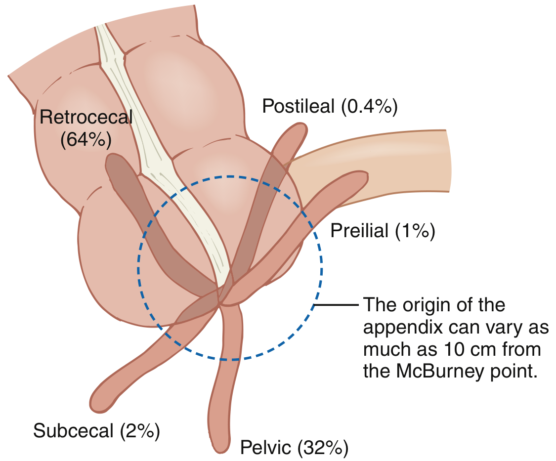 McBurney's point and appendix positions