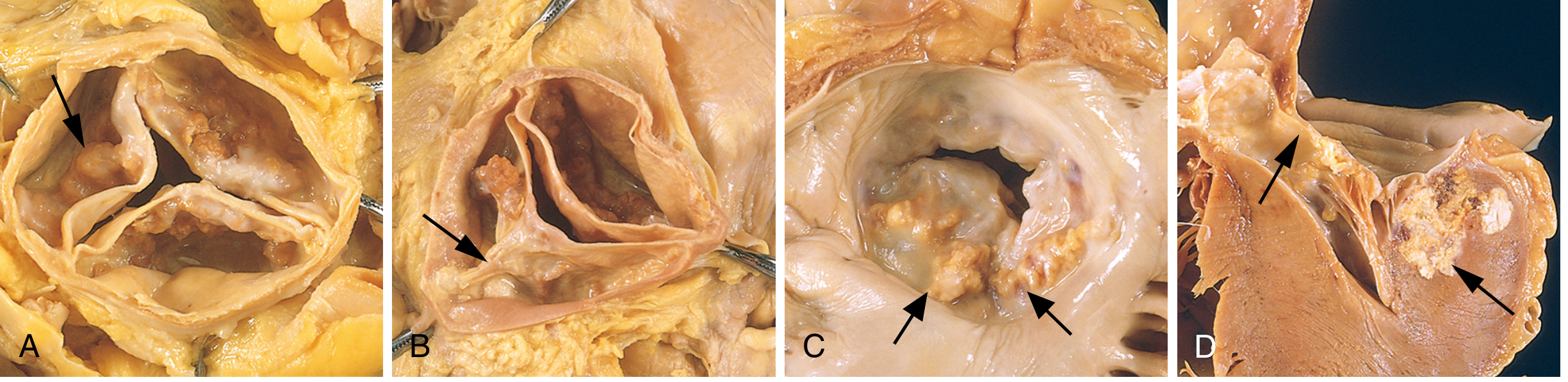 Calcific Aortic Stenosis - Dil ke valve par calcium ki ganthein