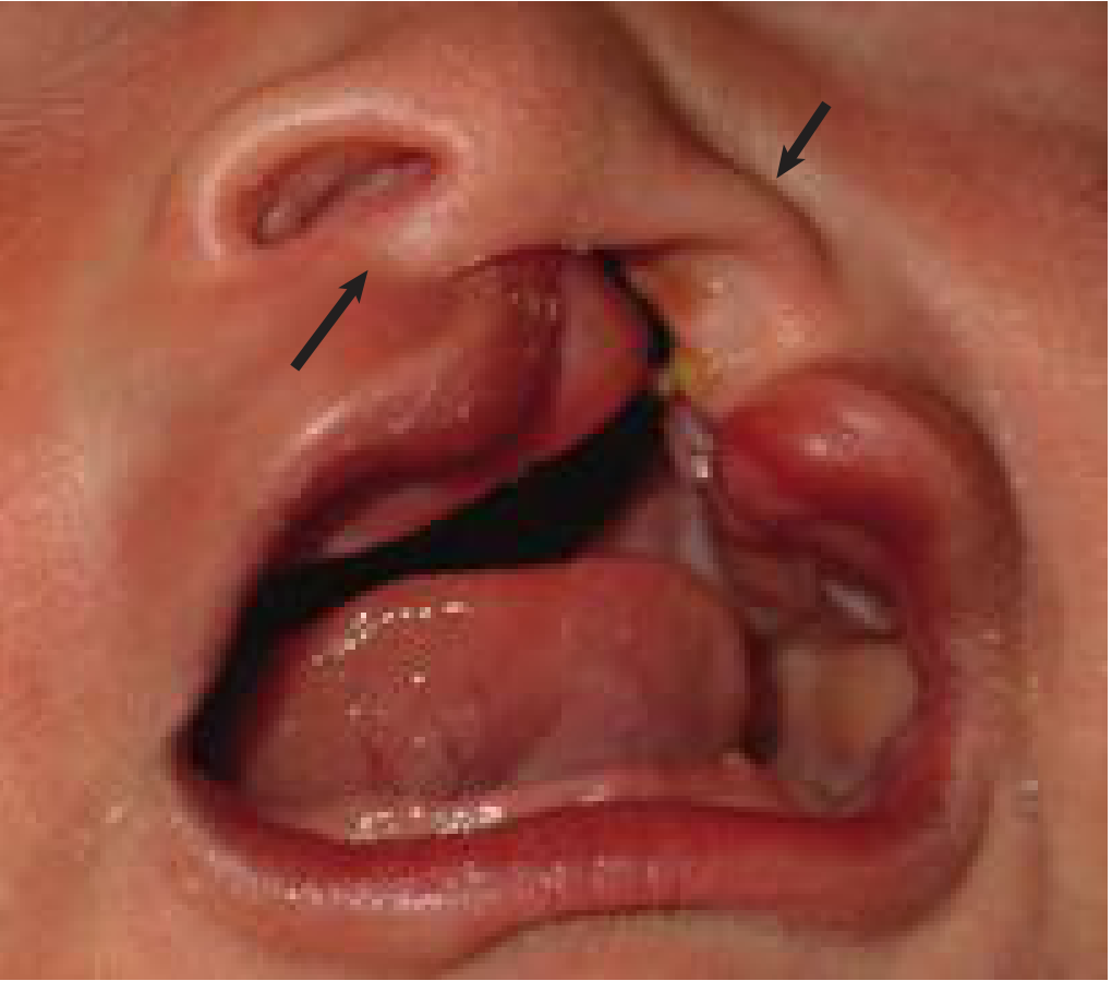 Complete unilateral left cleft lip and palate showing nasal septal deviation and lower lateral cartilage deformity