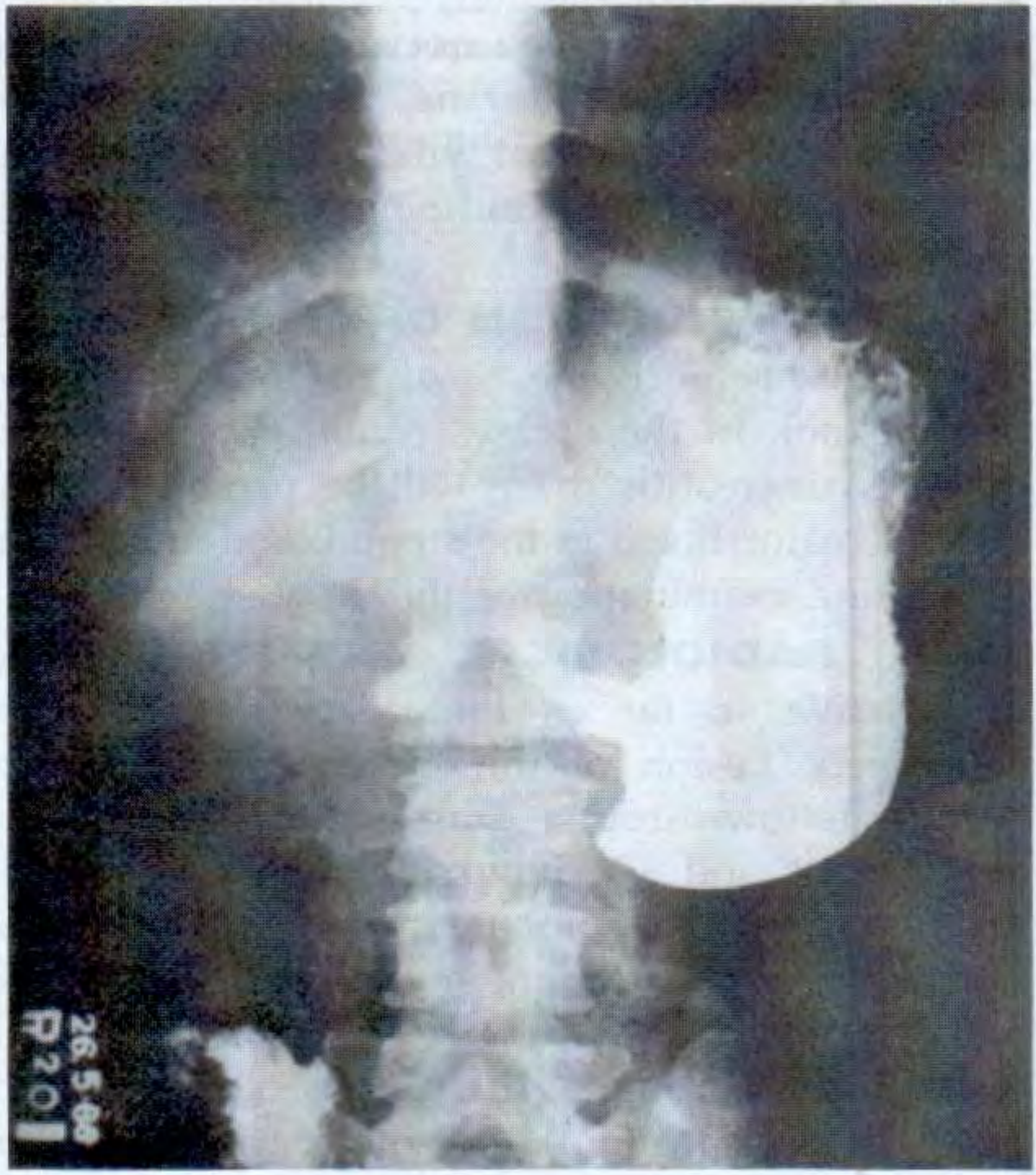 Carcinoma of stomach - Irregular filling defect of pyloric region due to gastric carcinoma (barium meal)