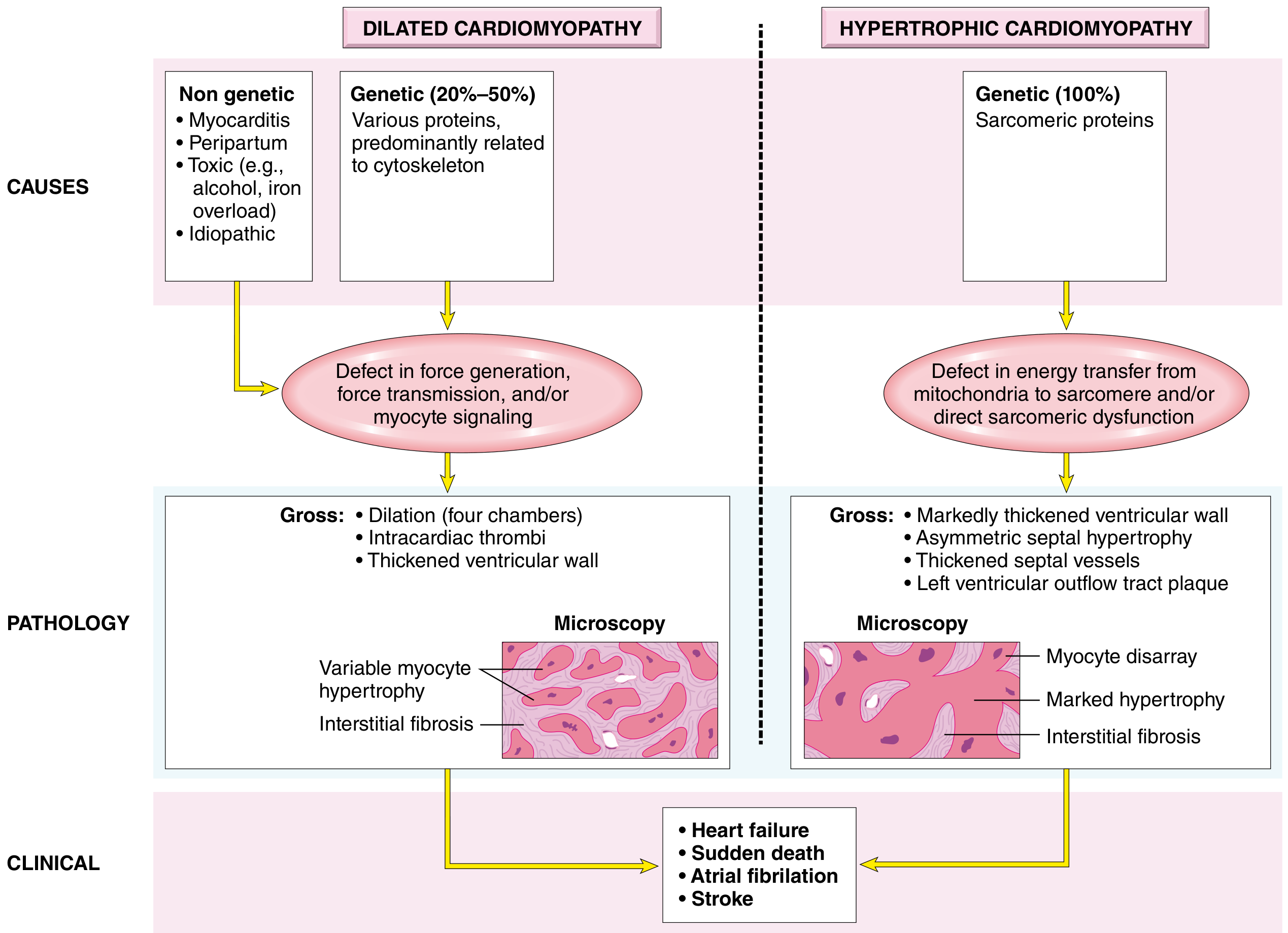 Causes and consequences of Dilated vs Hypertrophic Cardiomyopathy - from genetic/toxic causes to gross and microscopic pathology to clinical outcomes