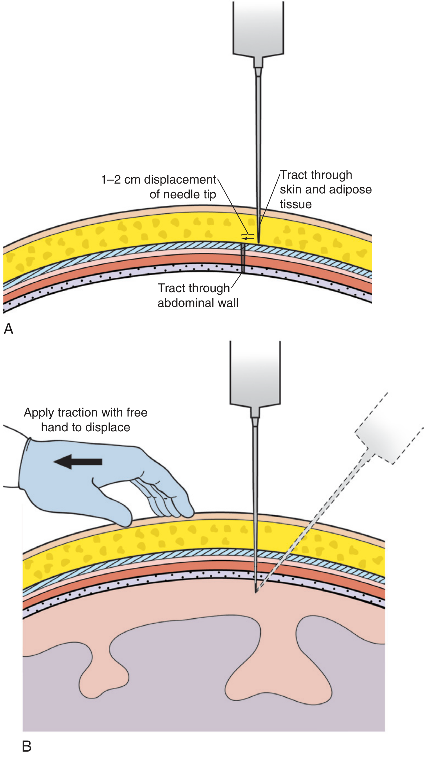Z-track technique showing skin displacement to create a non-linear tract and prevent post-procedural leakage