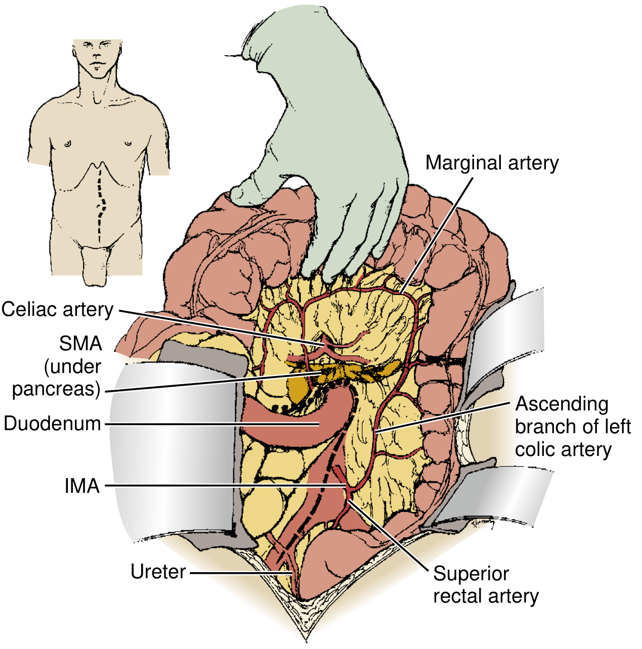 FIG. 4 — SMA operative exposure