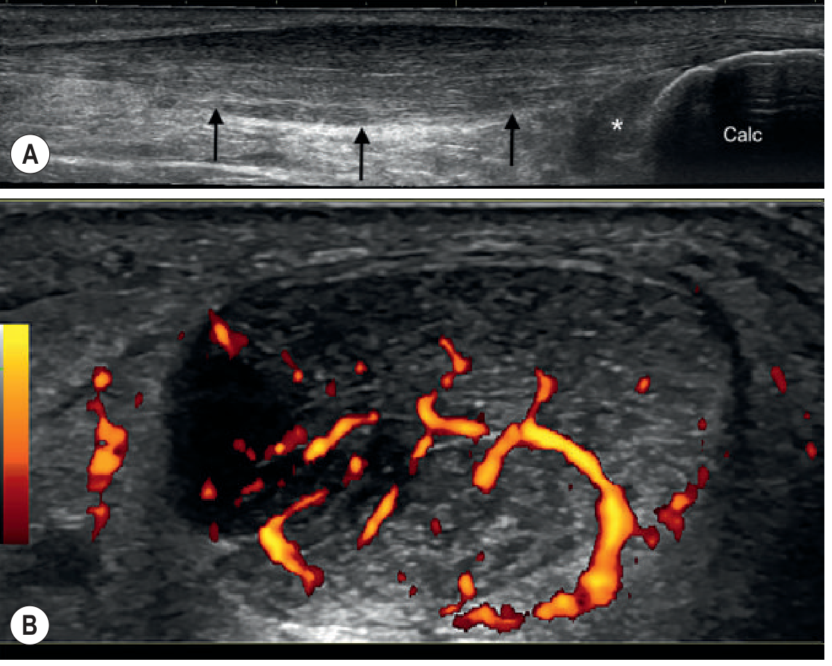 Achilles Tendinopathy - (A) sagittal ultrasound showing fusiform thickening with mixed echogenicity; (B) power Doppler showing neovascularization