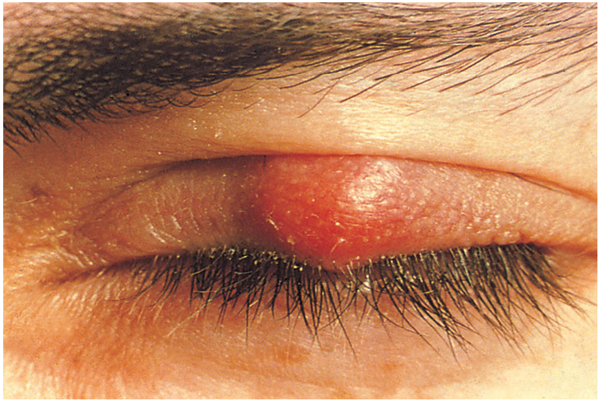 Meibomian cyst (chalazion) - Bailey & Love's Surgery