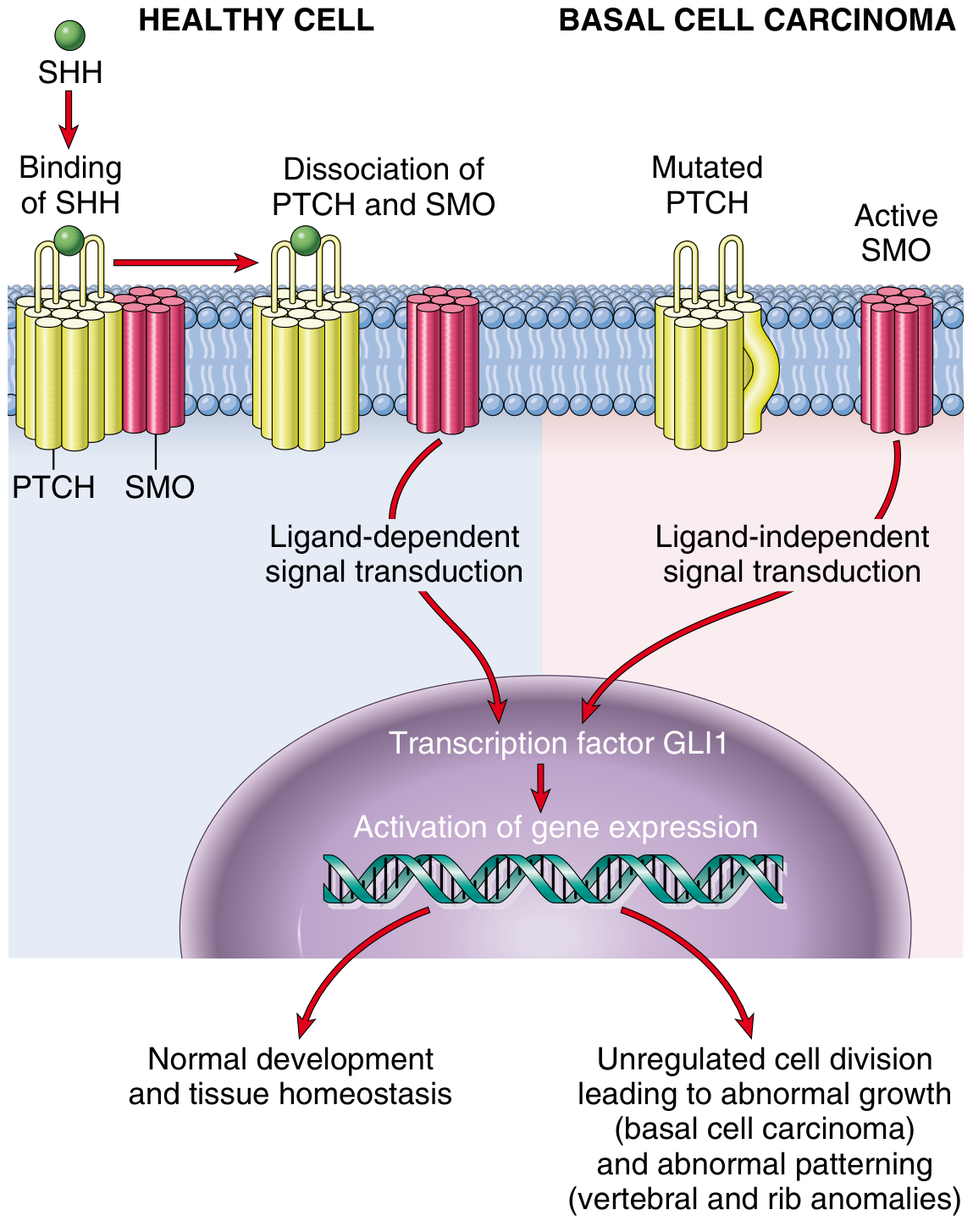 Hedgehog signaling pathway in normal cells vs BCC - showing PTCH mutation leads to constitutively active SMO, activating GLI1 transcription factor → unregulated cell division