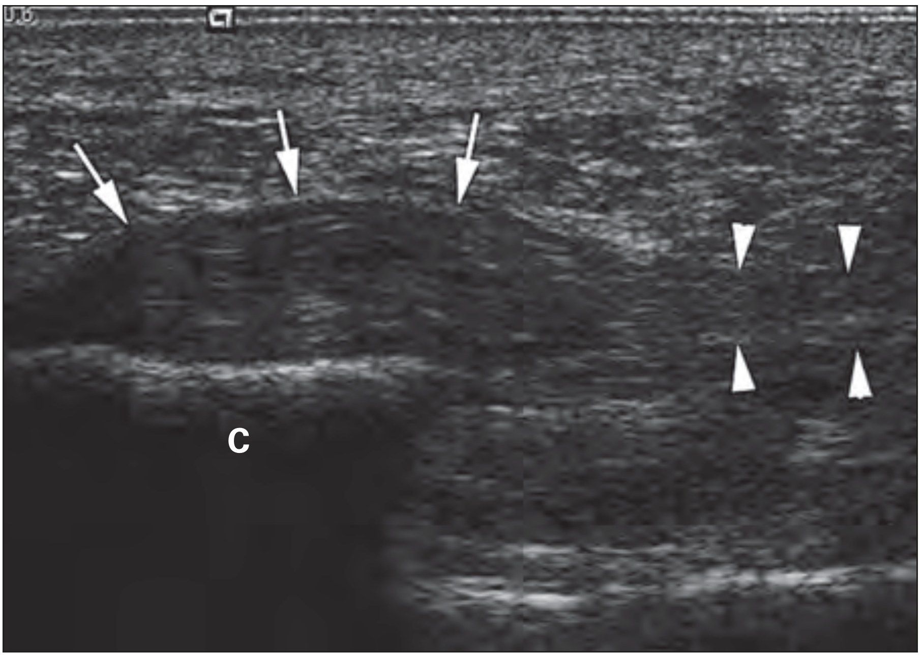 Ultrasound of plantar fasciitis showing marked thickening of fascia (arrows) at the calcaneus (C), with more normal structure distally (arrowheads)