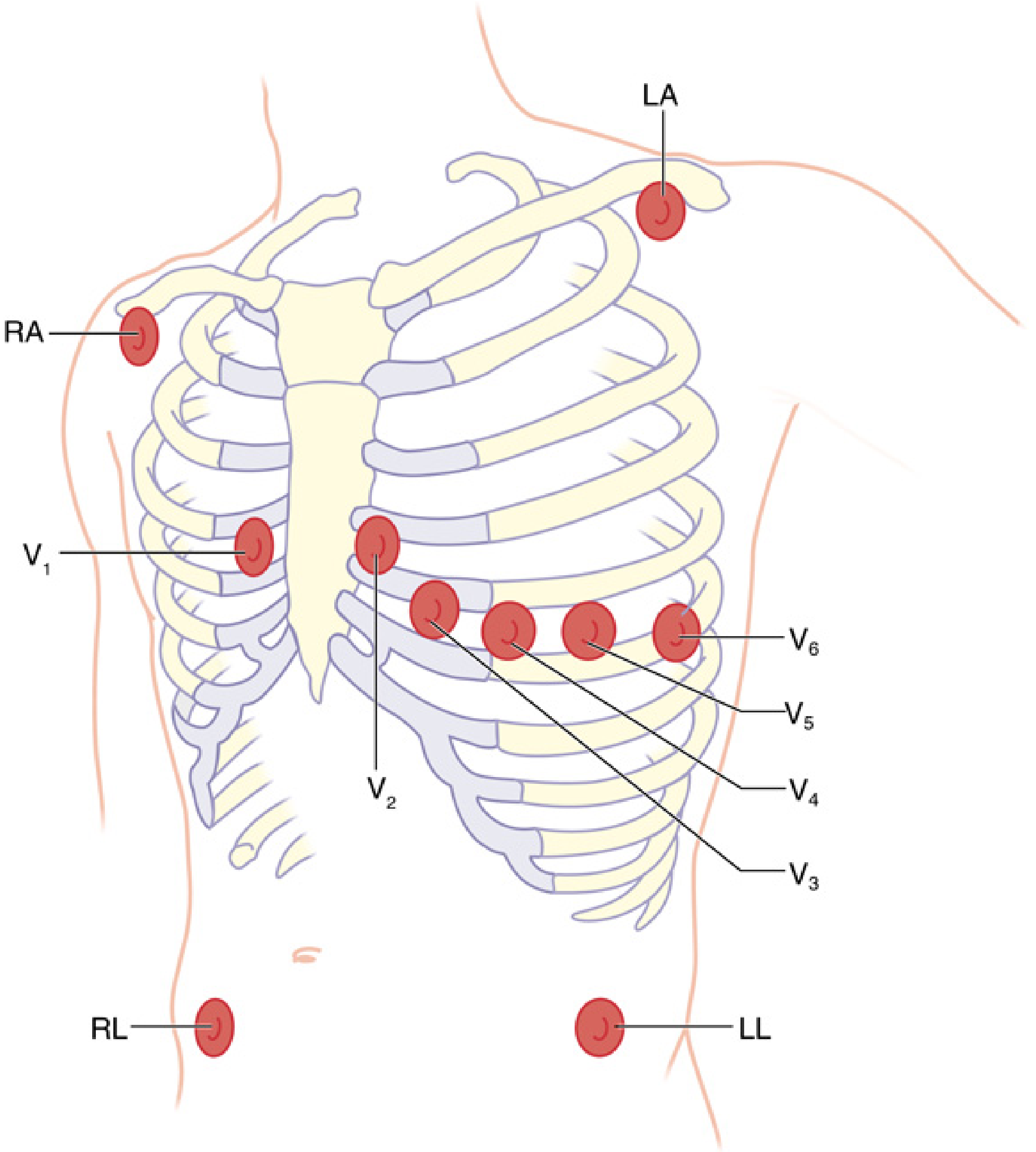 Full 12-lead ECG electrode placement diagram