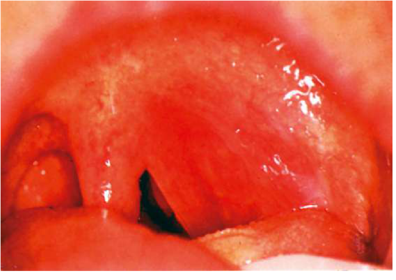 Left peritonsillar abscess - bulging anterior pillar, soft palate with midline shift