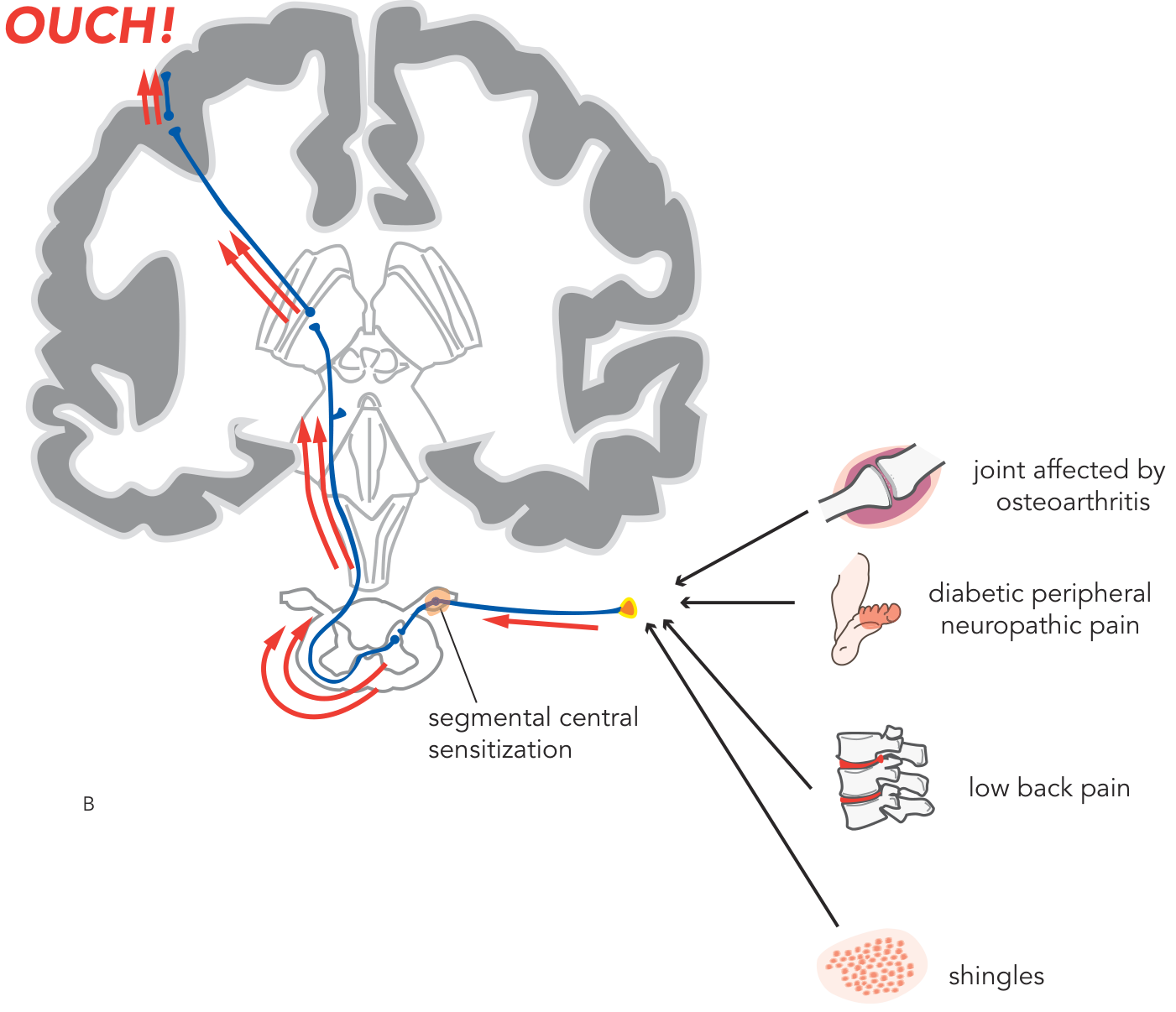Segmental central sensitization diagram showing peripheral input driving dorsal horn sensitization in conditions such as diabetic neuropathic pain and shingles