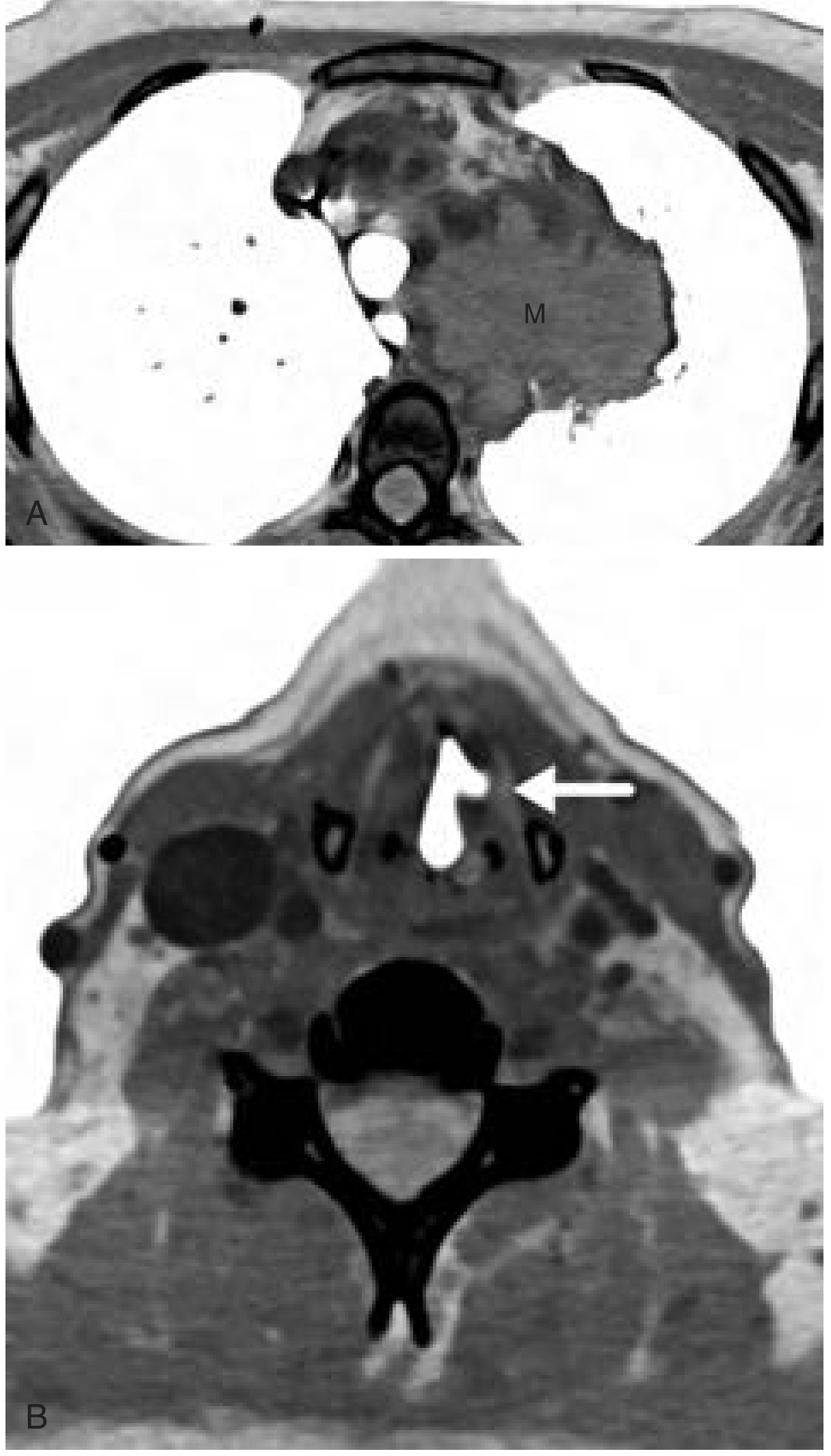 Left vocal cord paralysis on CT - paramedian cord and left upper lobe mass along RLN course