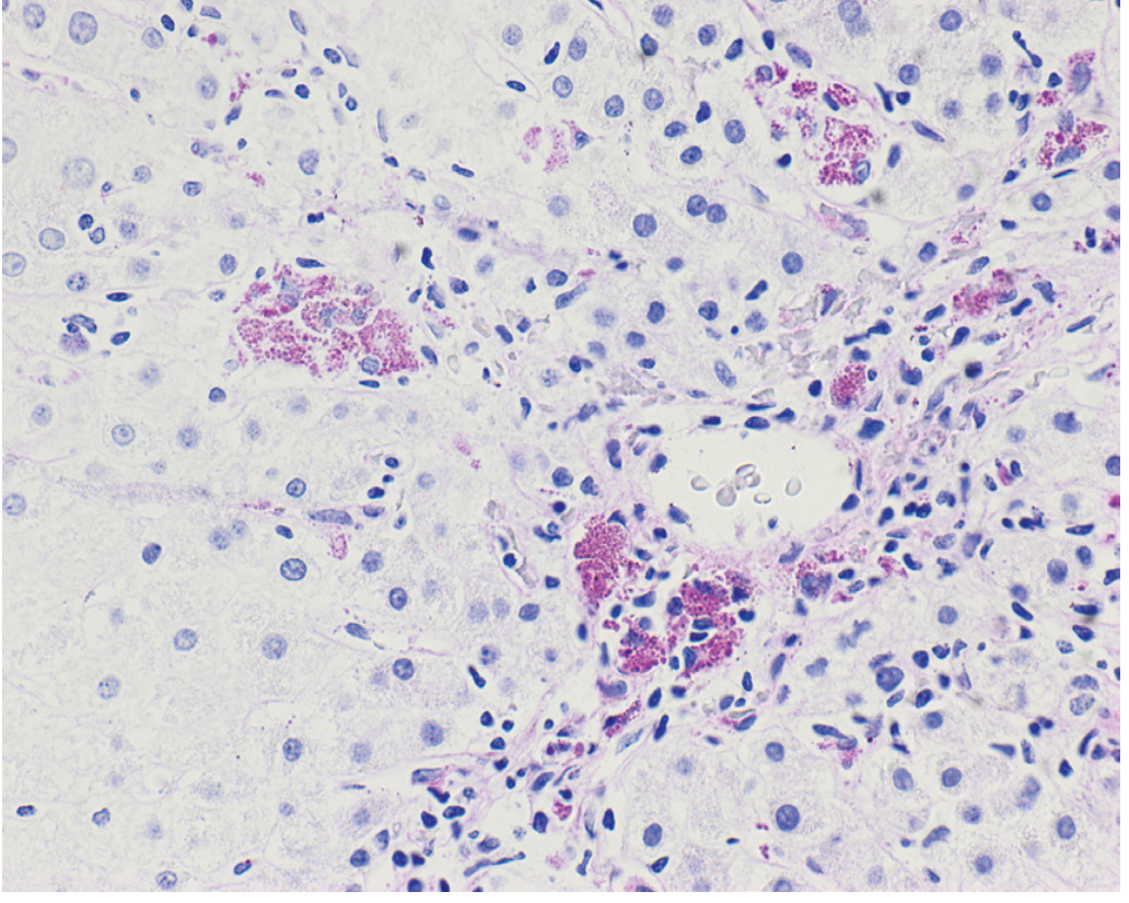 Hepatocyte apoptosis in chronic hepatitis C biopsy. Single arrows show scattered apoptotic hepatocytes ("acidophil bodies") - shrunken, deeply eosinophilic. Double arrows show patchy inflammatory infiltrate.