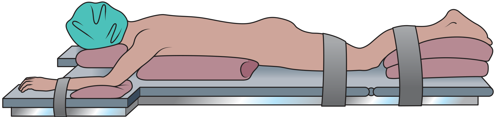 Prone position - patient face down with axillary and chest rolls, arm boards extended, padded support under shins