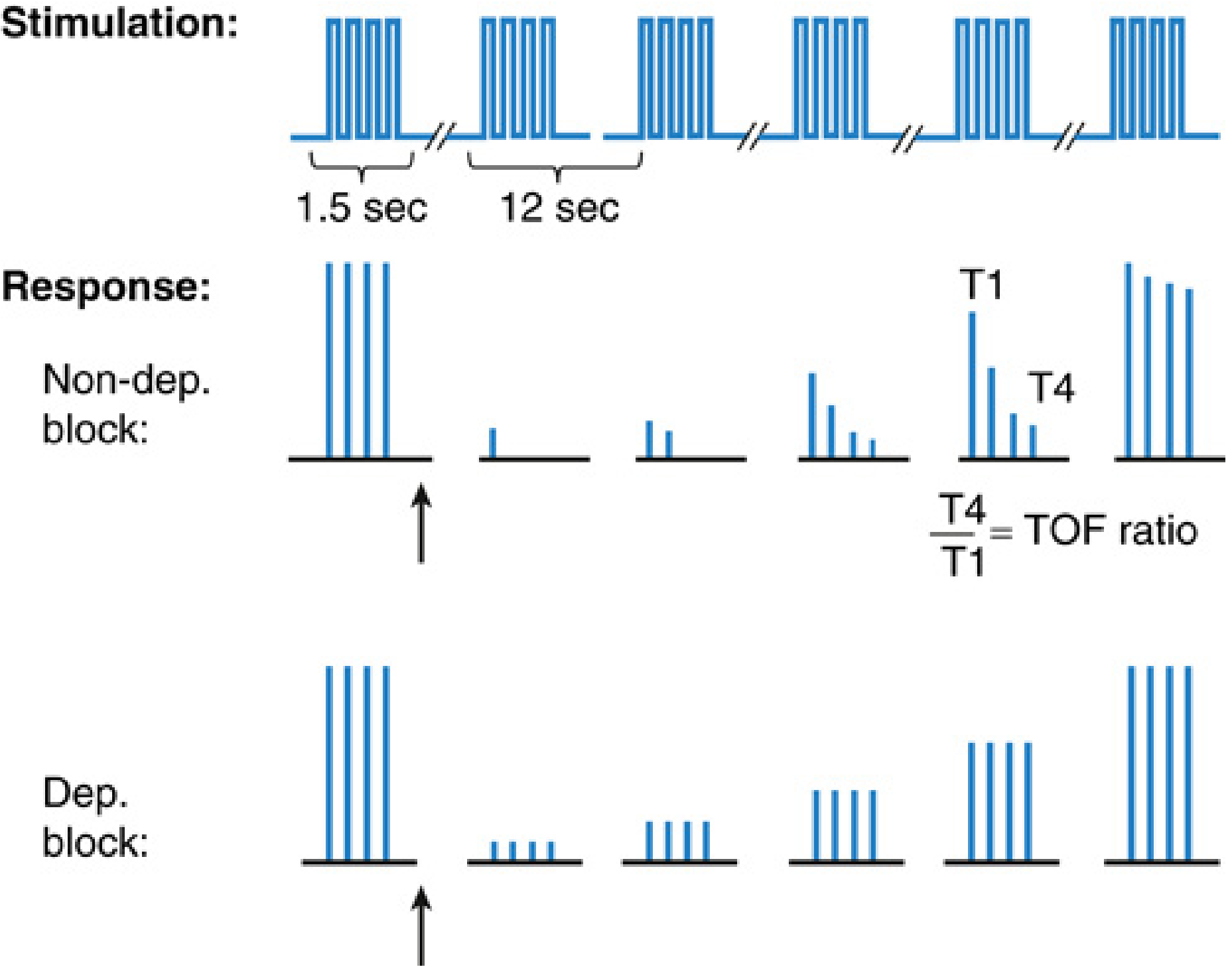 TOF stimulation — nondepolarizing (fade, T1>T4) vs depolarizing (uniform depression, no fade)