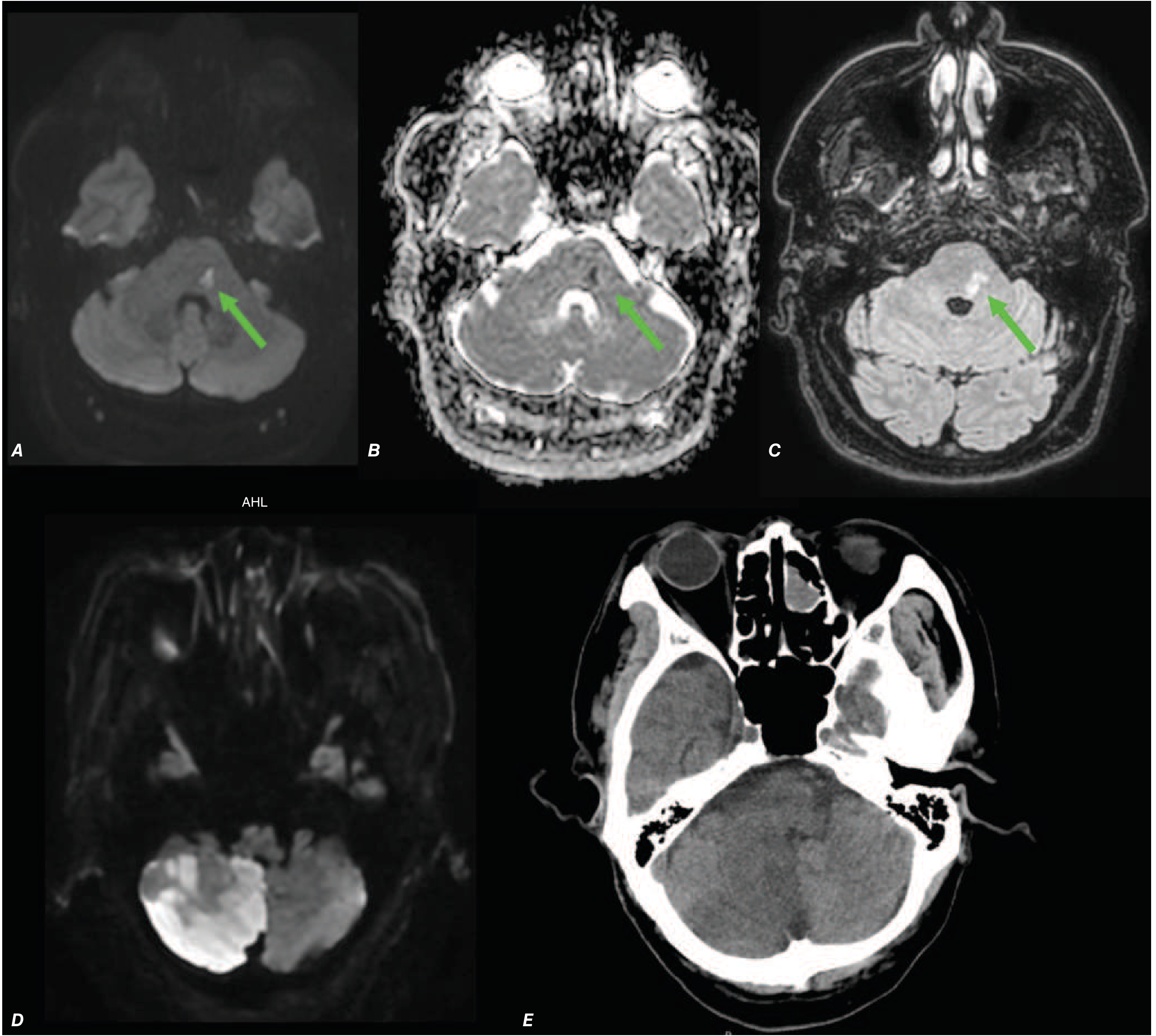 MRI showing DWI bright lesion (A), ADC dark (B), FLAIR change at 2 days (C)