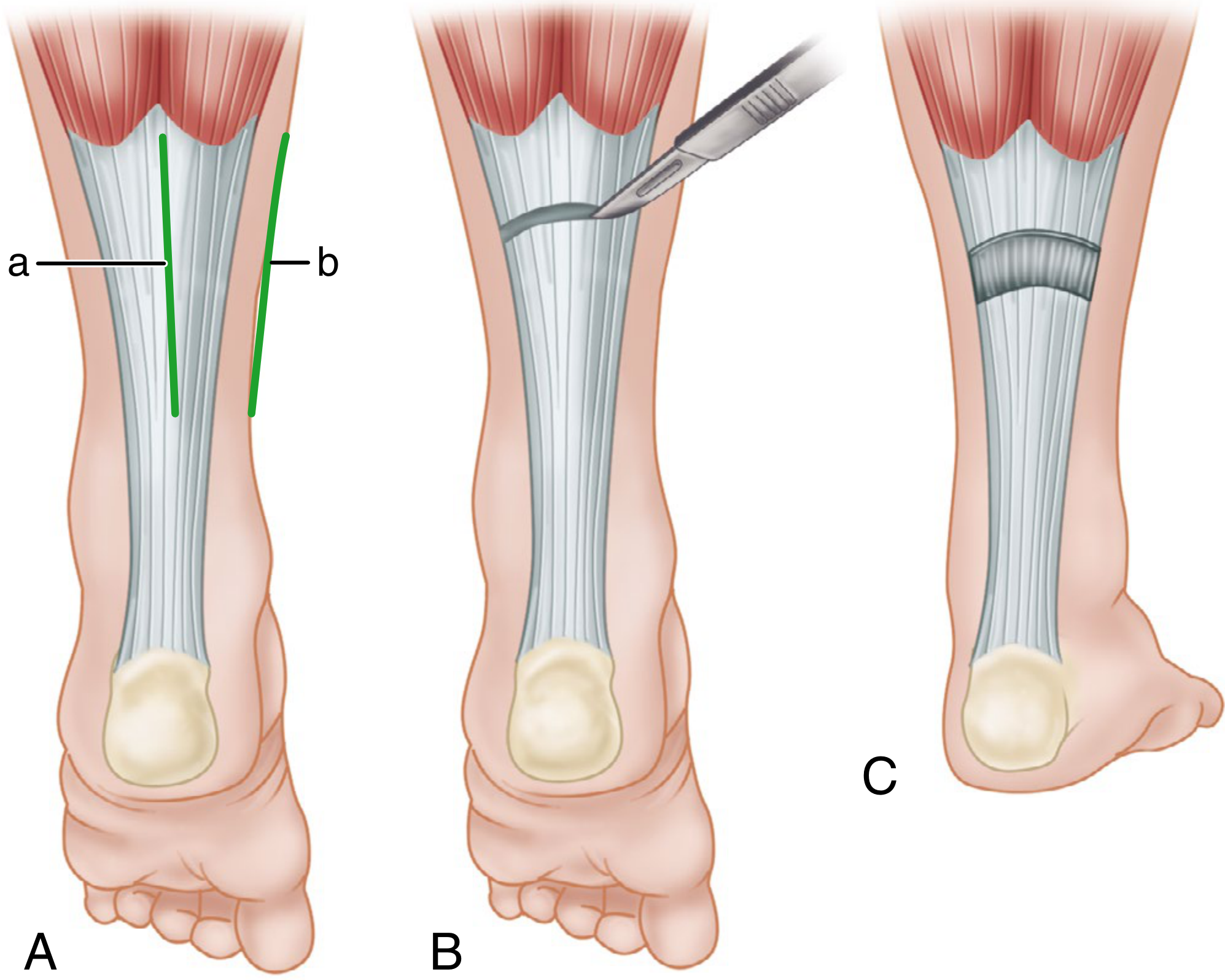 Gastrocnemius lengthening surgical steps