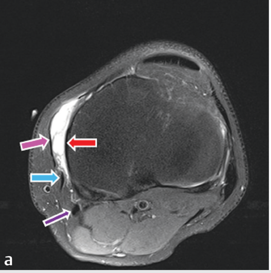 Axial MRI showing pes anserine bursitis with bright fluid between tendons and MCL