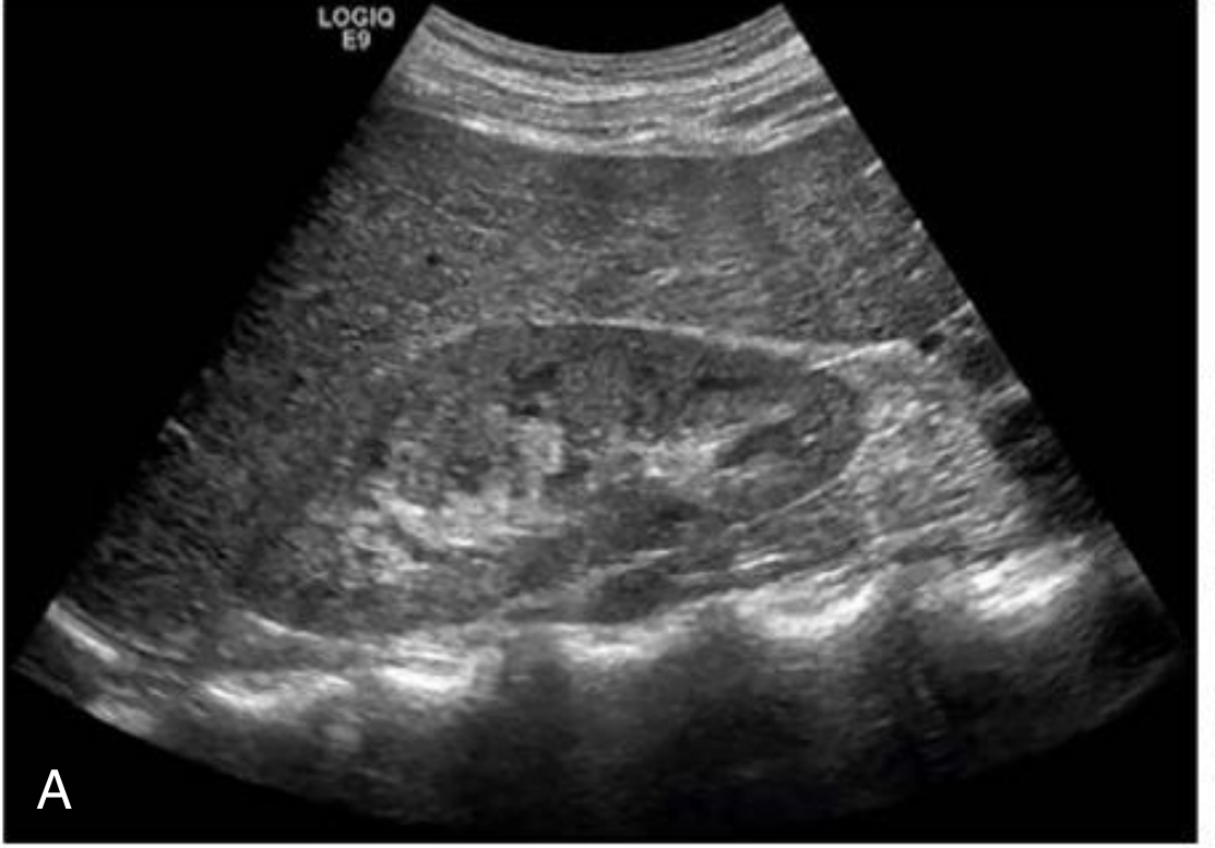 Normal kidney B-mode grayscale USG - showing corticomedullary architecture
