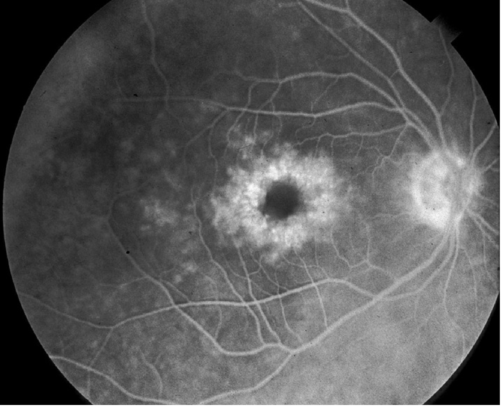 IVFA of cystoid macular edema showing petaloid/spoke-wheel pattern