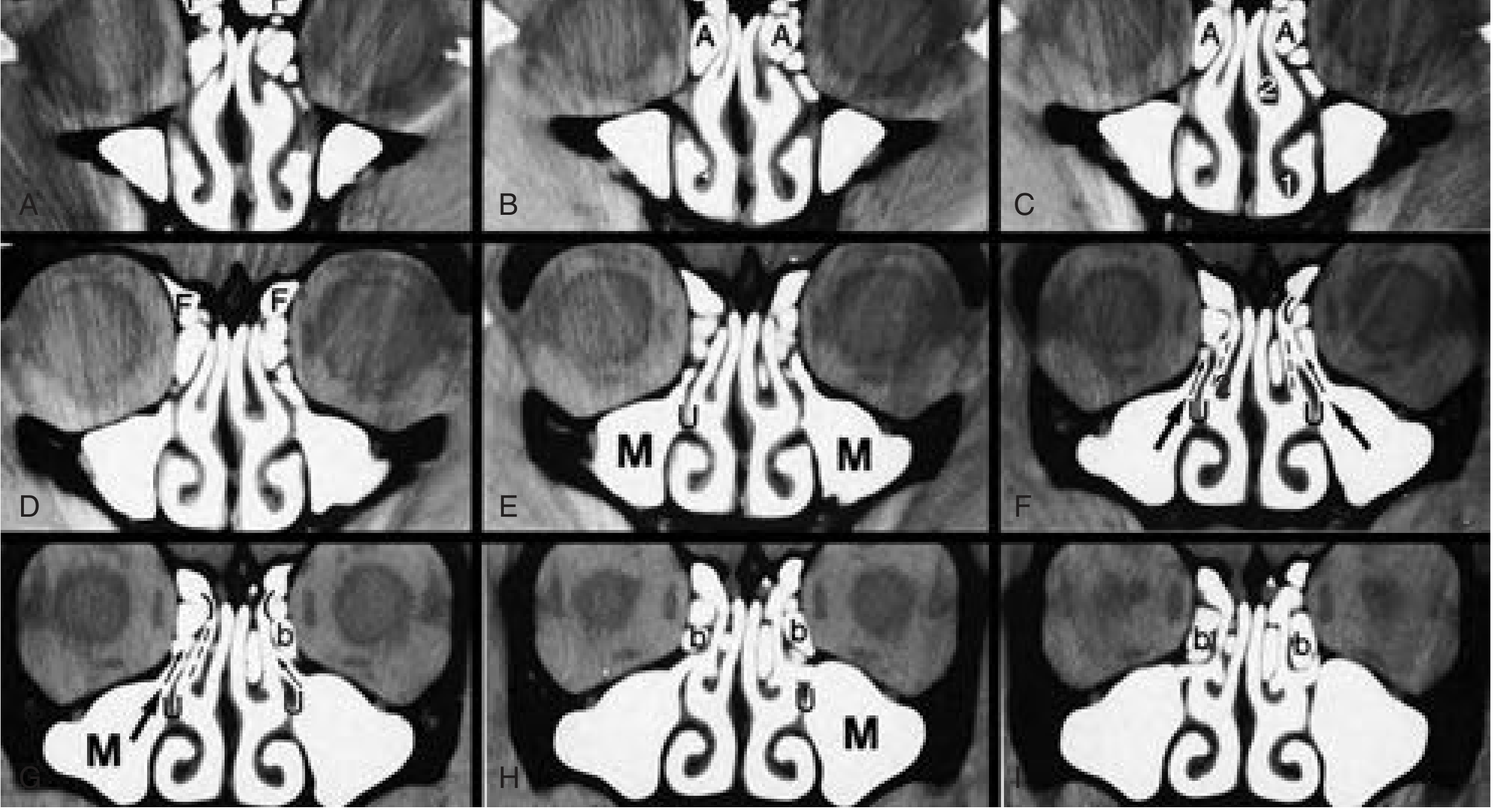 Coronal CT series A-I showing paranasal sinus anatomy: agger nasi (A), frontal sinus (F), maxillary sinus (M), uncinate process (U), ethmoid bulla (b), inferior turbinate (1), middle turbinate (2); the osteomeatal unit is visible in panels F-I