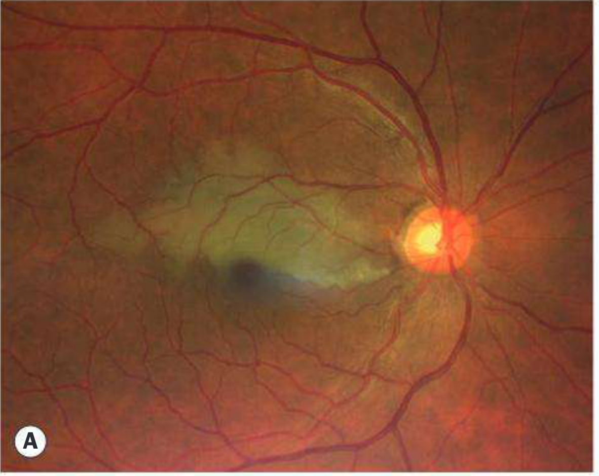 CRAO - cherry red spot, pale retina, ground-glass retinal oedema