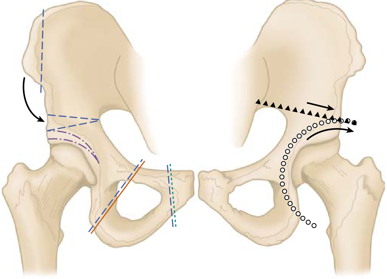 Pelvic Osteotomies for DDH - Salter, Sutherland, Pemberton, Chiari, Steel osteotomies illustrated on pelvis diagram