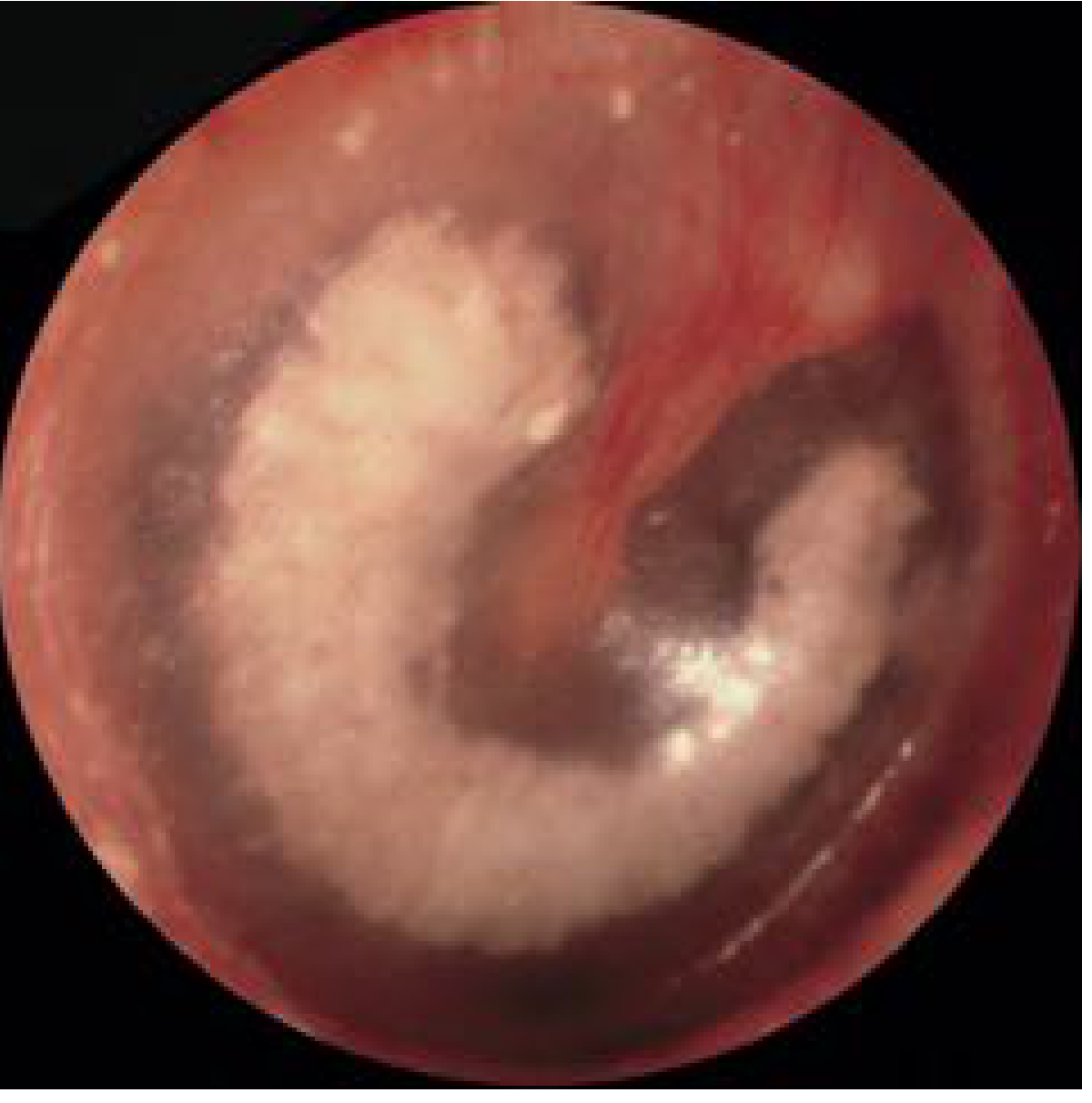 Tympanosclerosis (myringosclerosis) - chalk-white plaque visible on the tympanic membrane