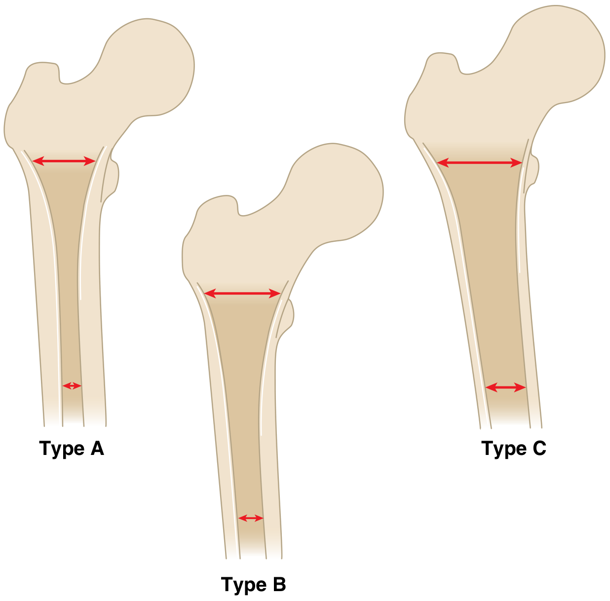 Dorr Classification - Types A, B, C