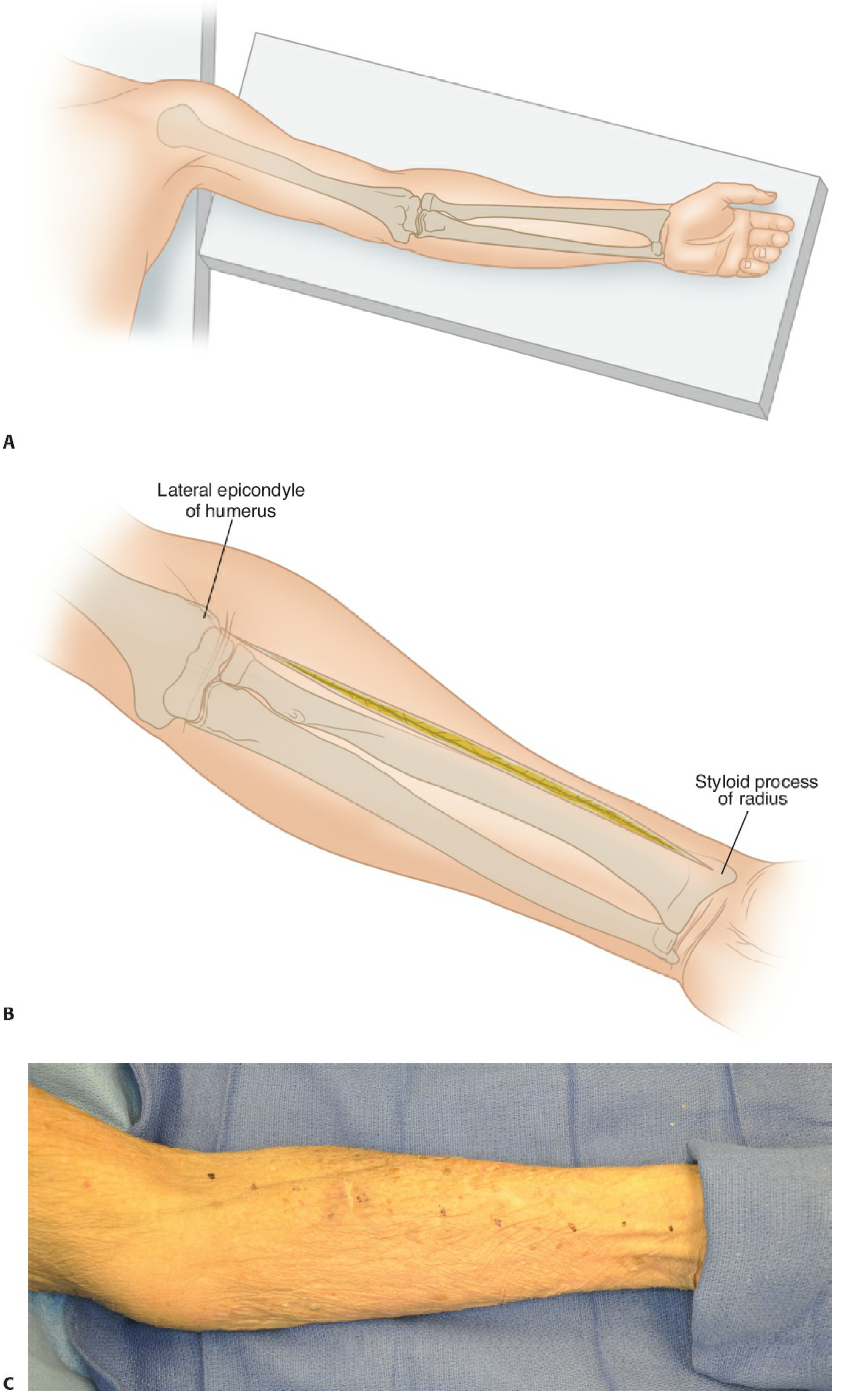 Patient positioned supine, arm on hand table, showing skin incision line from lateral biceps tendon to radial styloid
