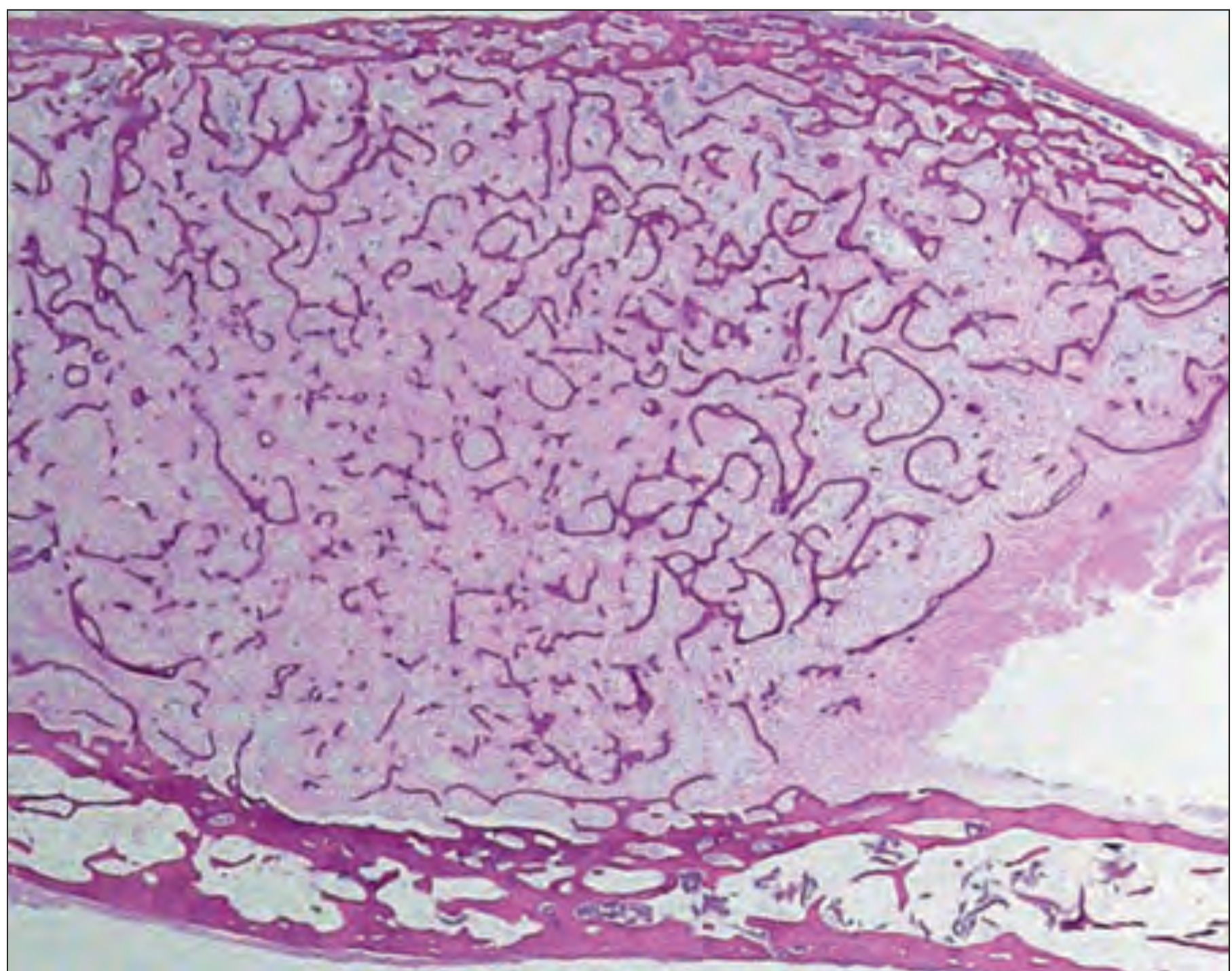 Fibrous dysplasia - Low power H&E showing curvilinear woven bone trabeculae in fibrous stroma